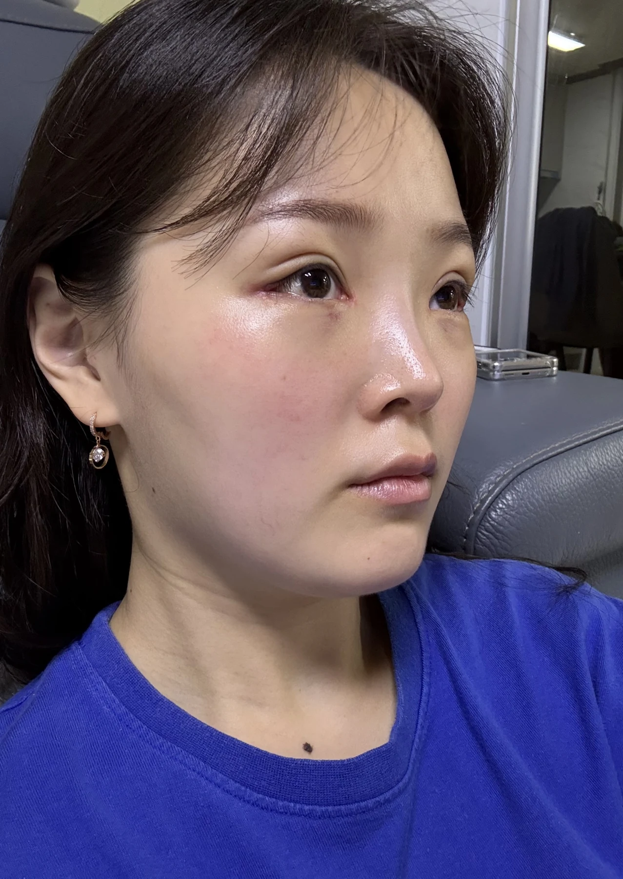 Eyelid and inner-corner surgery: six-month photo diary · Case 066 at Answer Plastic Surgery. Opposite angled view — 1 week, eyelid and inner-corner surgery at Answer Plastic Surgery (case 066).