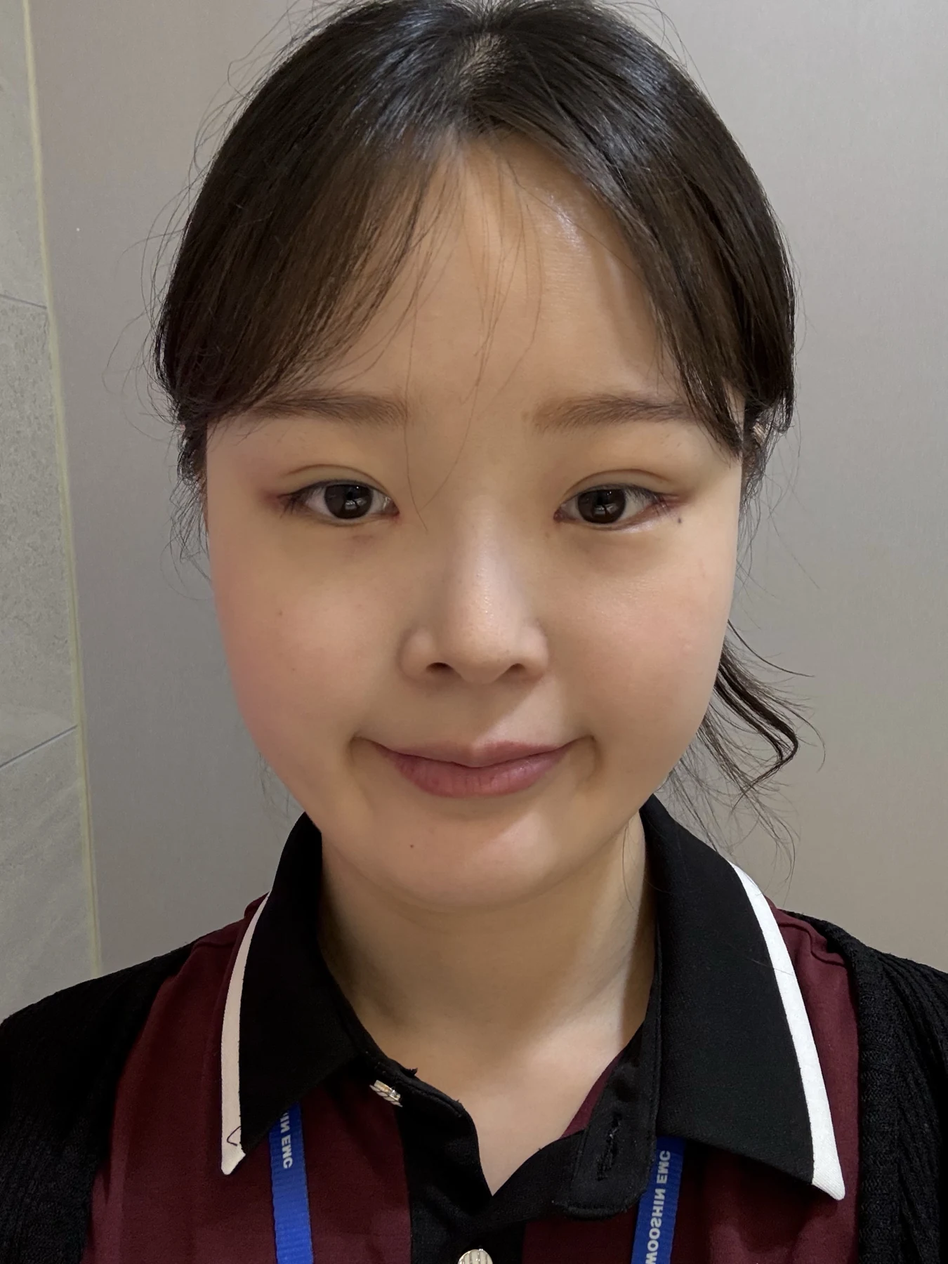 Eyelid and inner-corner surgery: six-month photo diary · Case 066 at Answer Plastic Surgery. Front view — 2 weeks, eyelid and inner-corner surgery at Answer Plastic Surgery (case 066).