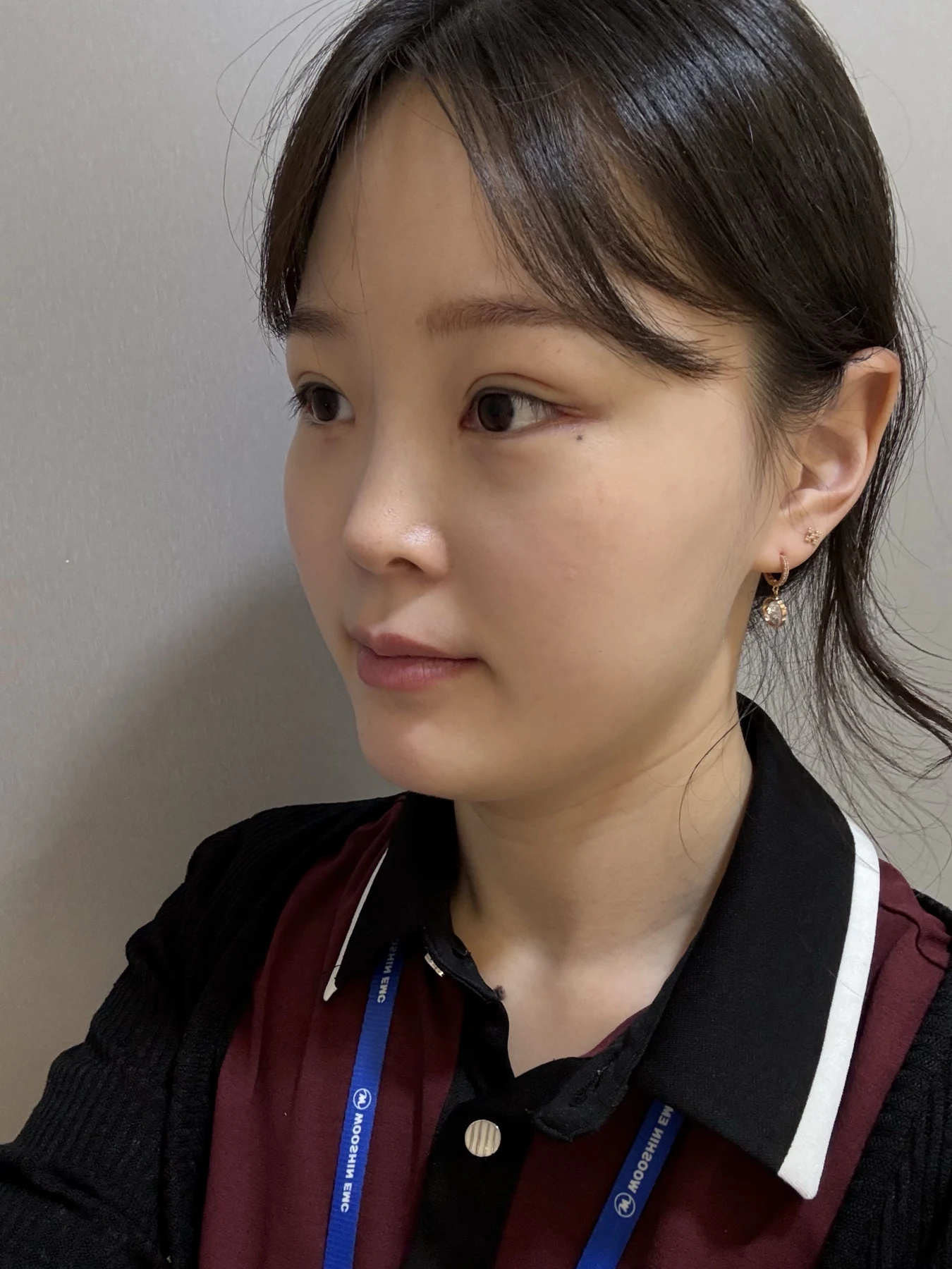 Eyelid and inner-corner surgery: six-month photo diary · Case 066 at Answer Plastic Surgery. Angled view — 2 weeks, eyelid and inner-corner surgery at Answer Plastic Surgery (case 066).