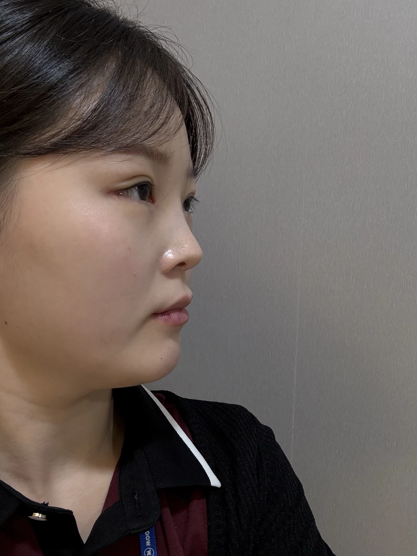 Eyelid and inner-corner surgery: six-month photo diary · Case 066 at Answer Plastic Surgery. Opposite angled view — 2 weeks, eyelid and inner-corner surgery at Answer Plastic Surgery (case 066).