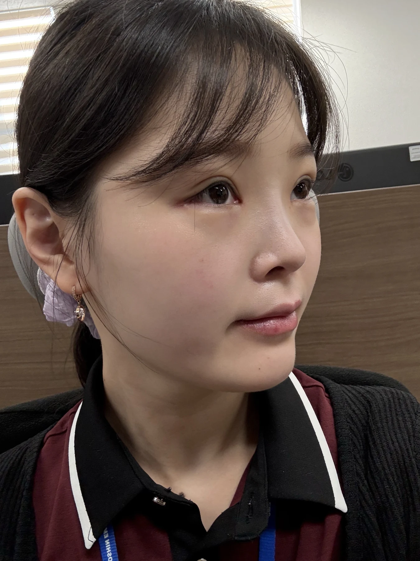 Eyelid and inner-corner surgery: six-month photo diary · Case 066 at Answer Plastic Surgery. Angled view — 3 weeks, eyelid and inner-corner surgery at Answer Plastic Surgery (case 066).