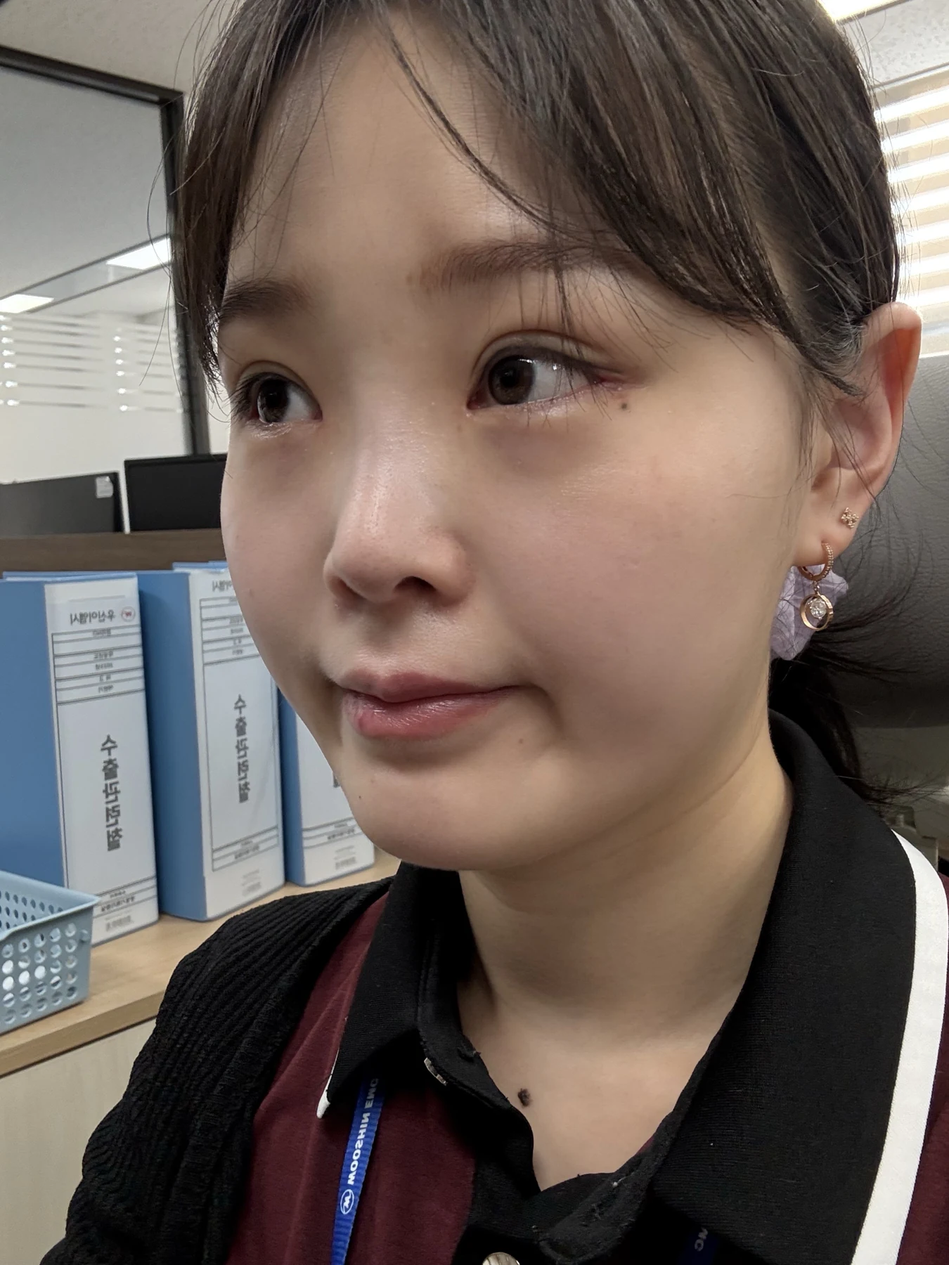 Eyelid and inner-corner surgery: six-month photo diary · Case 066 at Answer Plastic Surgery. Opposite angled view — 3 weeks, eyelid and inner-corner surgery at Answer Plastic Surgery (case 066).
