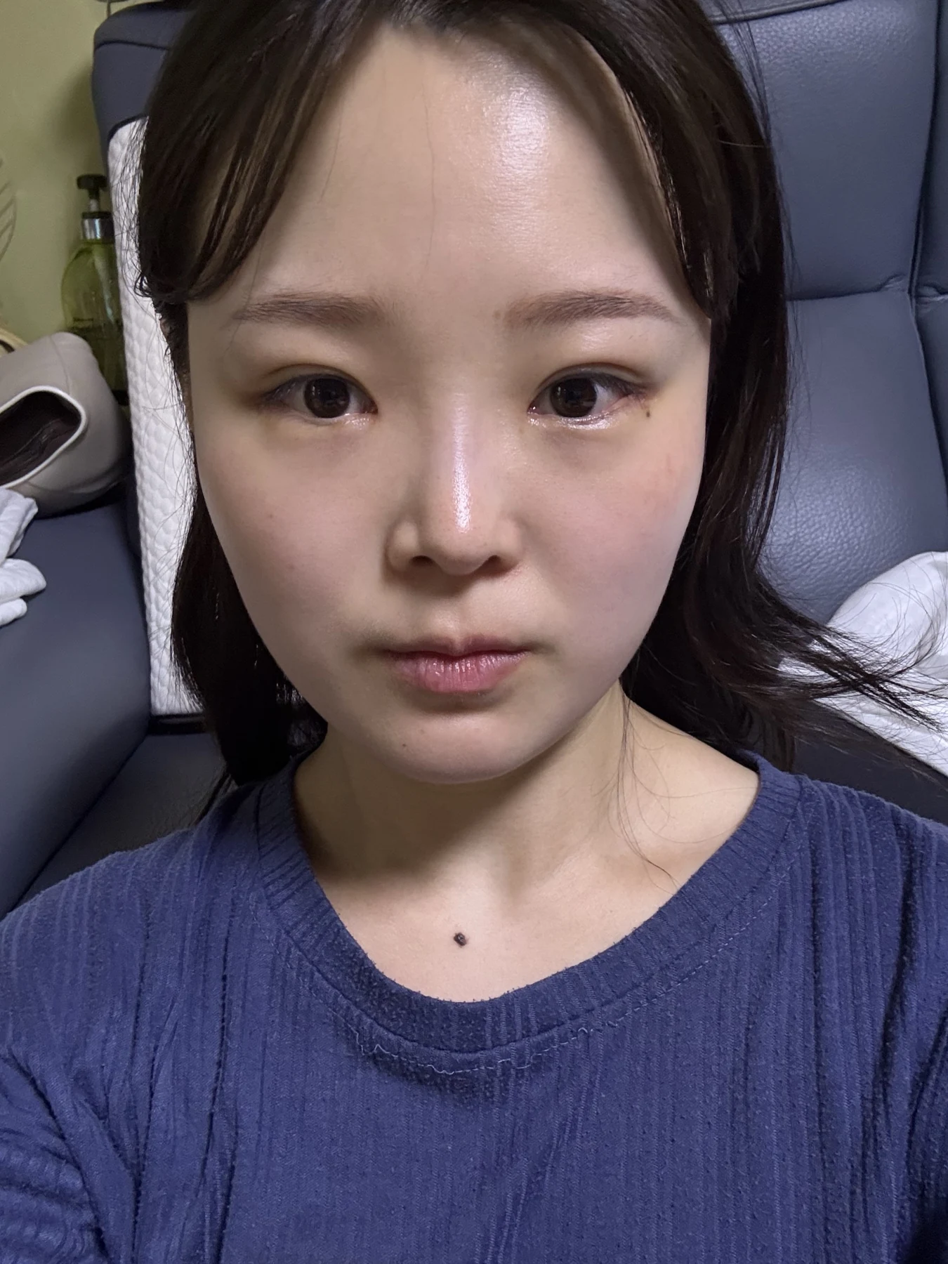 Eyelid and inner-corner surgery: six-month photo diary · Case 066 at Answer Plastic Surgery. Front view — 1 month, eyelid and inner-corner surgery at Answer Plastic Surgery (case 066).