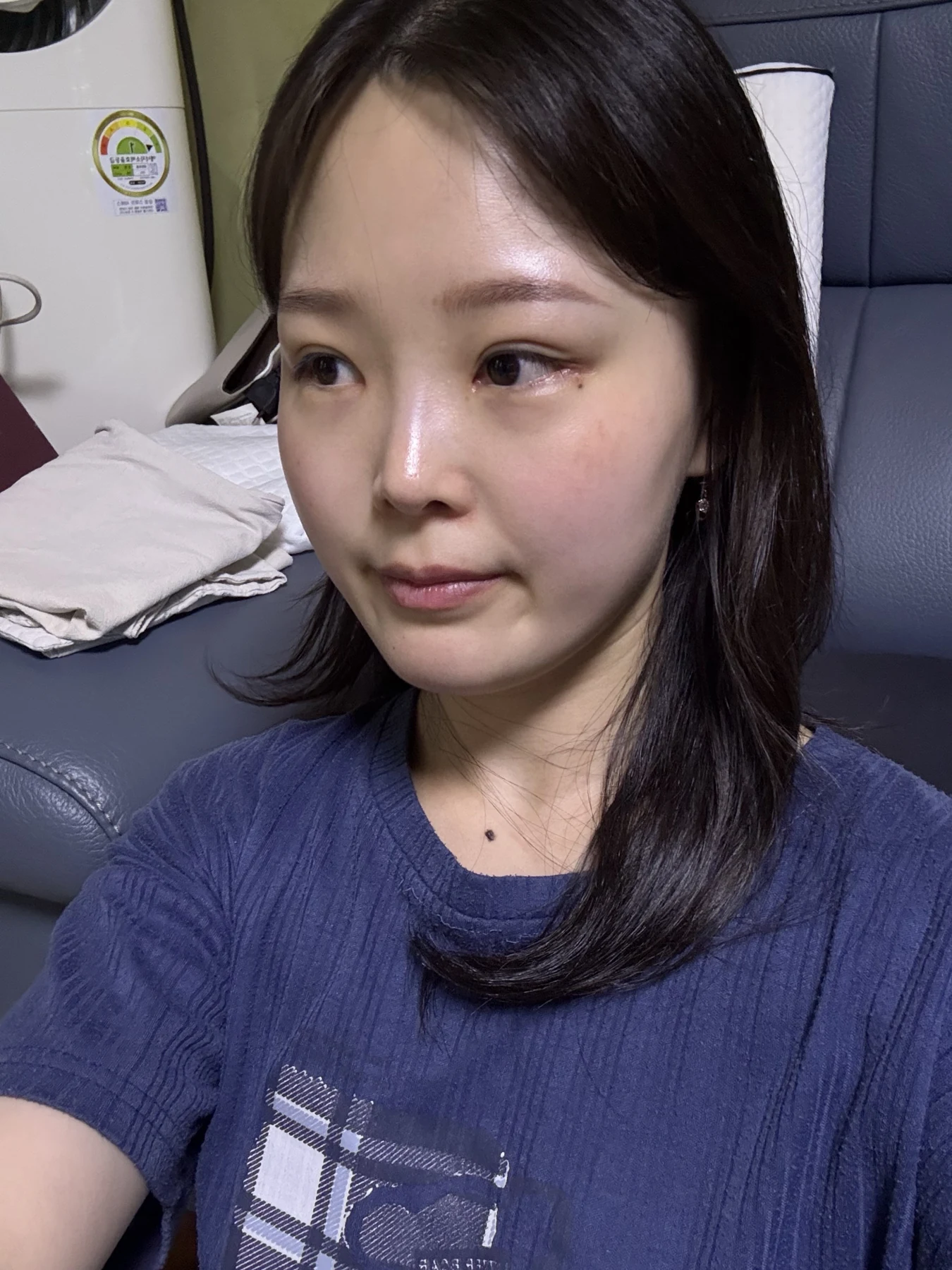 Eyelid and inner-corner surgery: six-month photo diary · Case 066 at Answer Plastic Surgery. Angled view — 1 month, eyelid and inner-corner surgery at Answer Plastic Surgery (case 066).