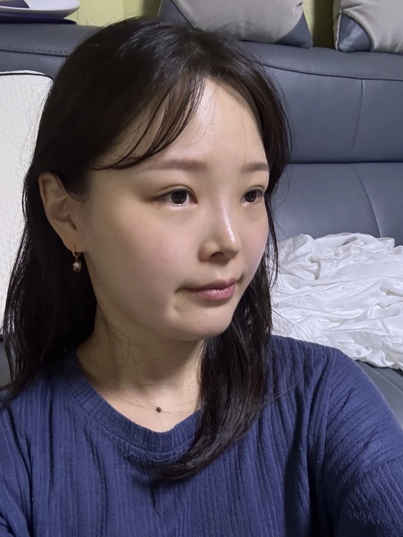 Eyelid and inner-corner surgery: six-month photo diary · Case 066 at Answer Plastic Surgery. Opposite angled view — 1 month, eyelid and inner-corner surgery at Answer Plastic Surgery (case 066).