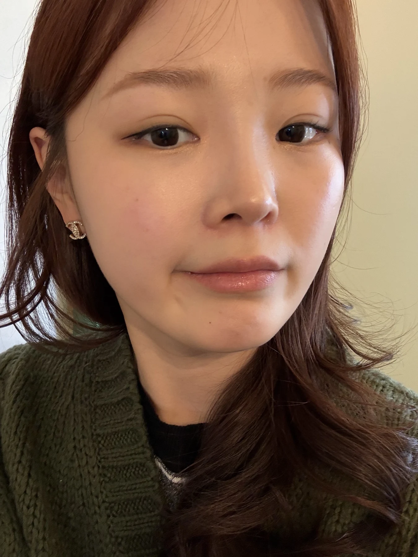 Eyelid and inner-corner surgery: six-month photo diary · Case 066 at Answer Plastic Surgery. Front-facing selfie — 6 months, eyelid and inner-corner surgery at Answer Plastic Surgery (case 066).