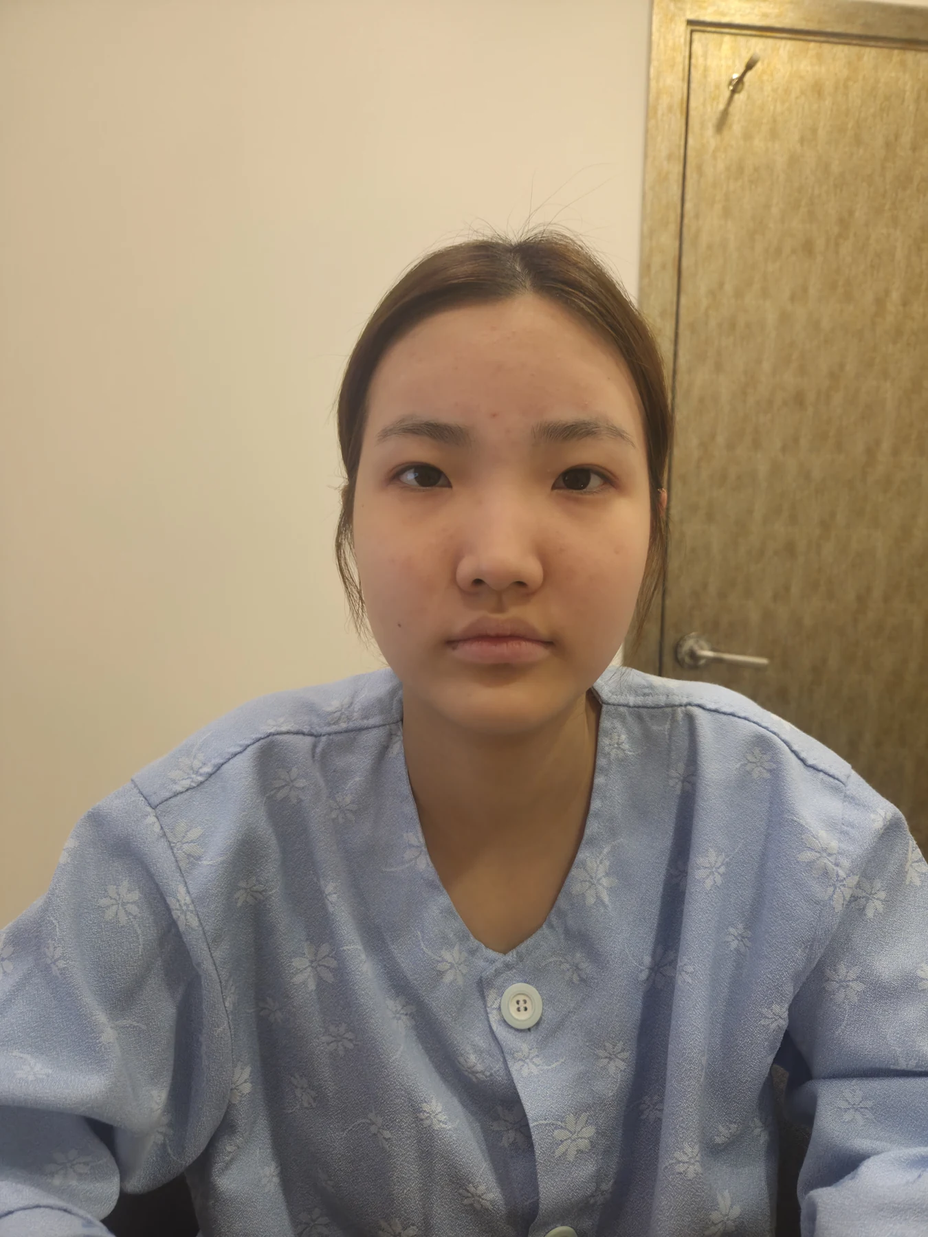 Eye-area surgery: before photos and one-month follow-up · Case 067 at Answer Plastic Surgery. Front view — before, eye-area surgery at Answer Plastic Surgery (case 067).