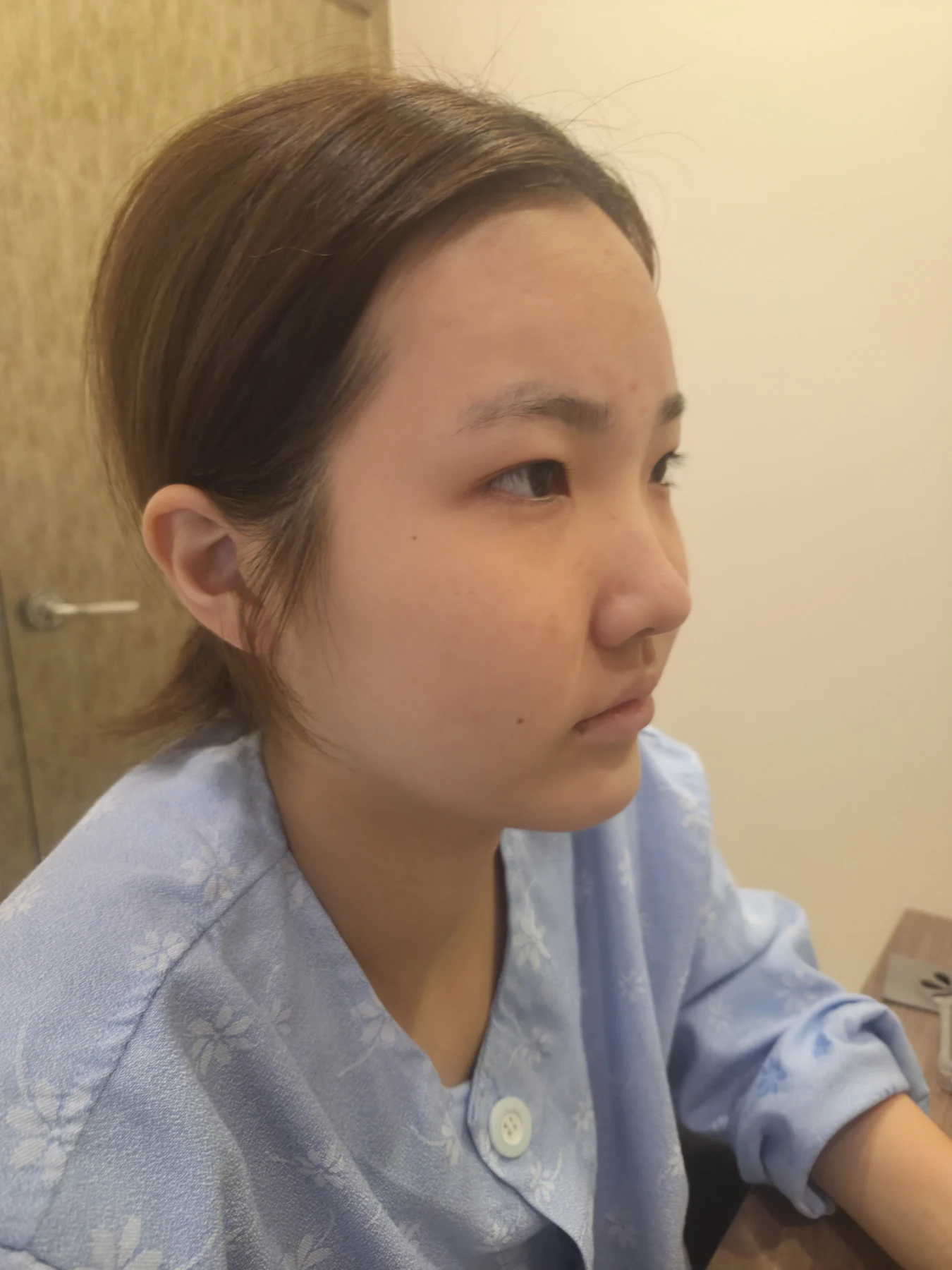 Eye-area surgery: before photos and one-month follow-up · Case 067 at Answer Plastic Surgery. Angled view — before, eye-area surgery at Answer Plastic Surgery (case 067).