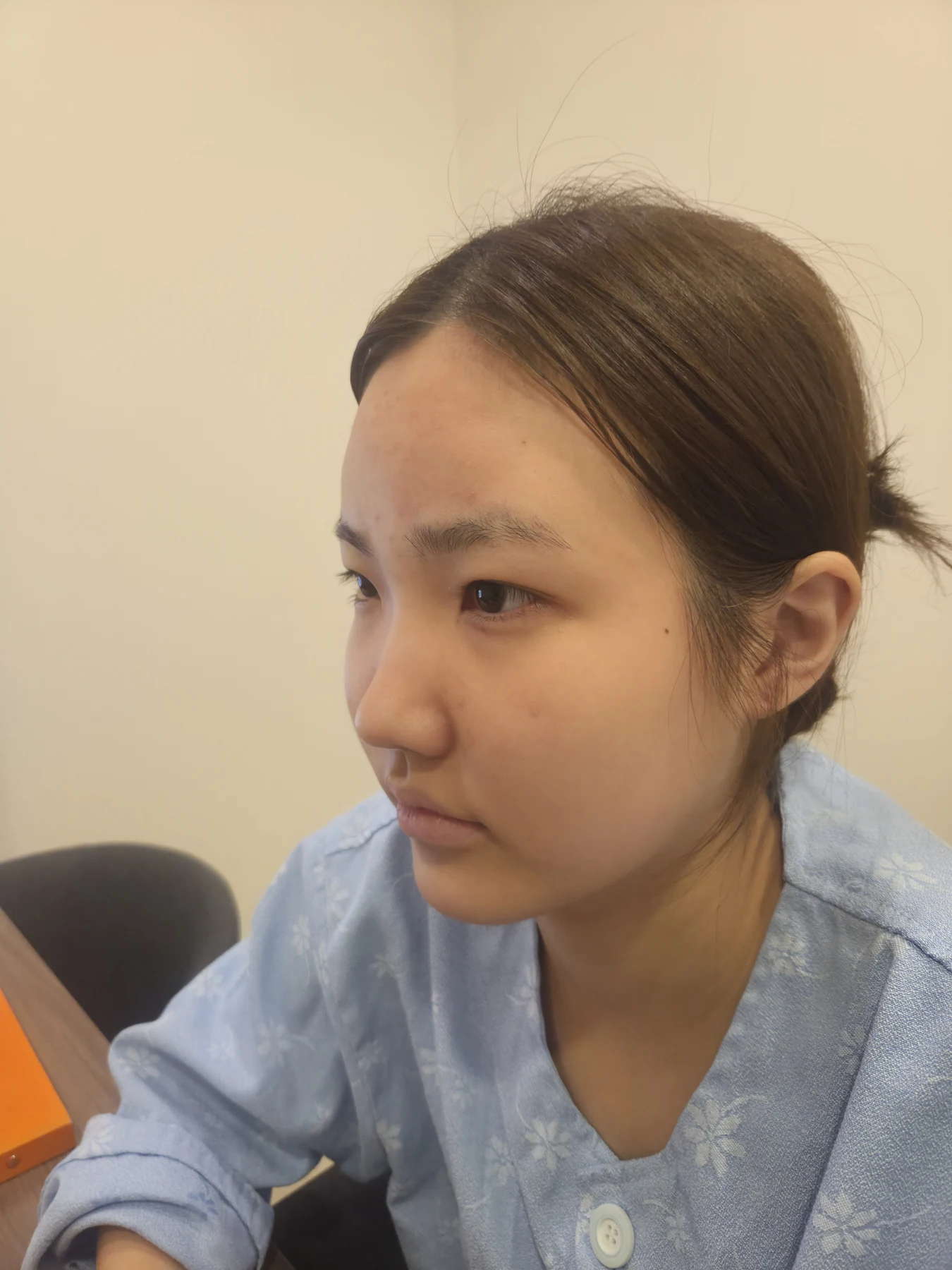 Eye-area surgery: before photos and one-month follow-up · Case 067 at Answer Plastic Surgery. Additional angled view — before, eye-area surgery at Answer Plastic Surgery (case 067).