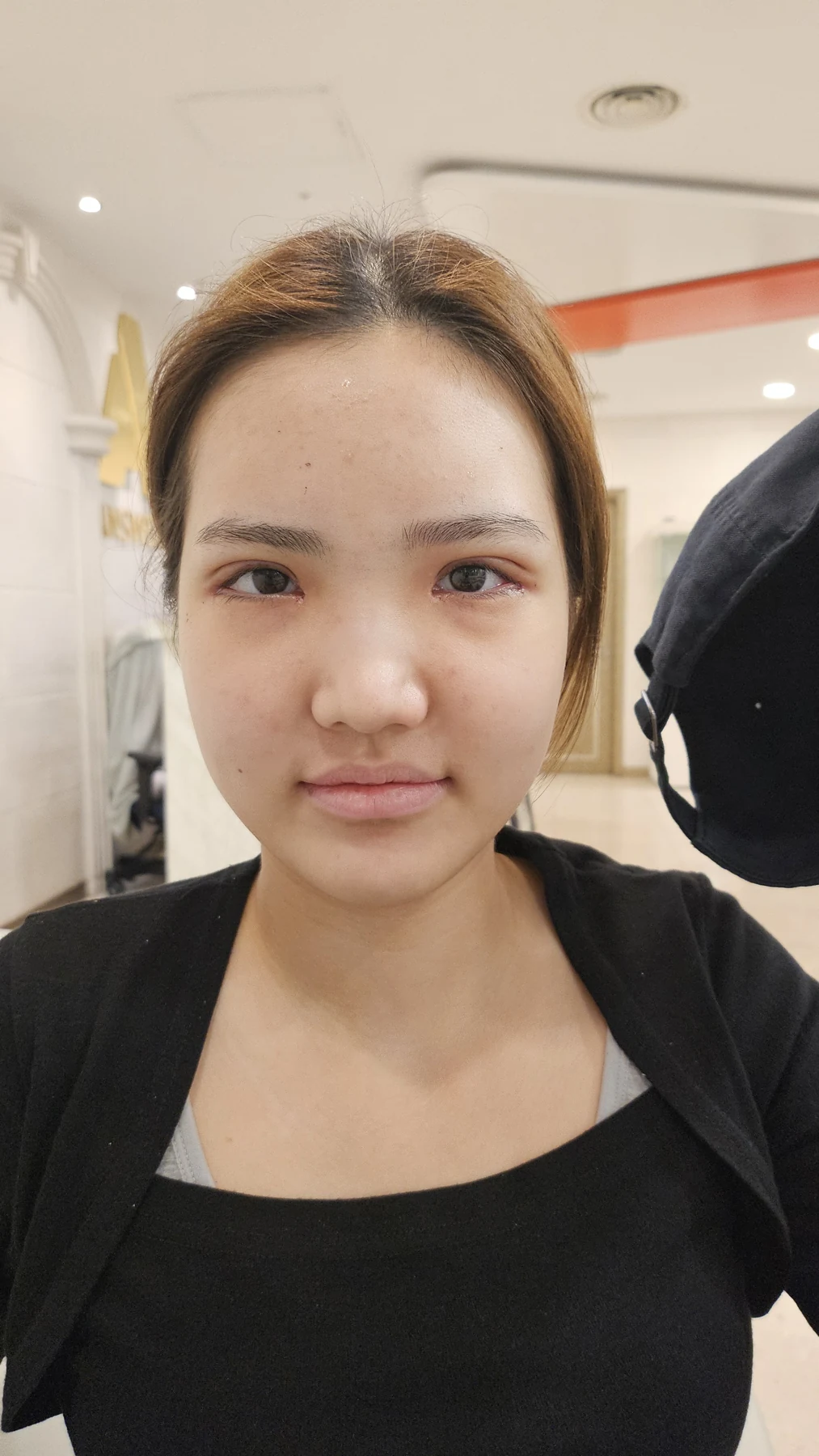 Eye-area surgery: before photos and one-month follow-up · Case 067 at Answer Plastic Surgery. Front view — 1 week, eye-area surgery at Answer Plastic Surgery (case 067).