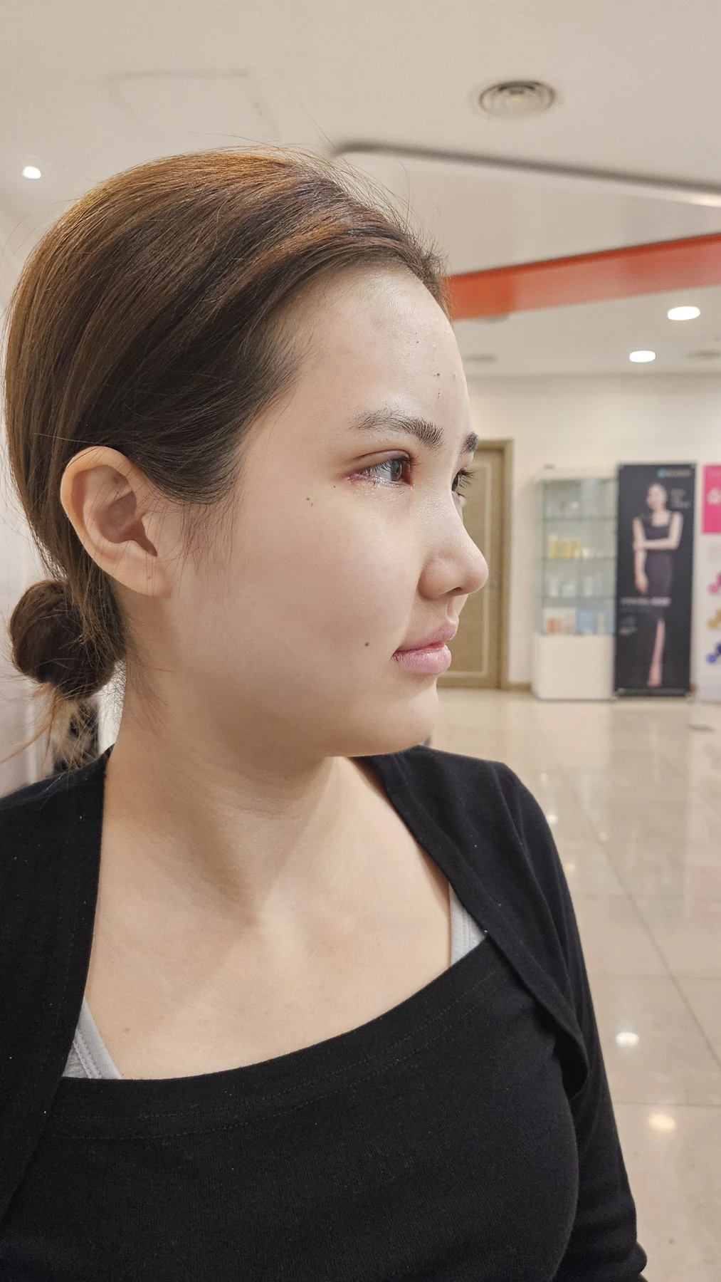 Eye-area surgery: before photos and one-month follow-up · Case 067 at Answer Plastic Surgery. Angled view — 1 week, eye-area surgery at Answer Plastic Surgery (case 067).