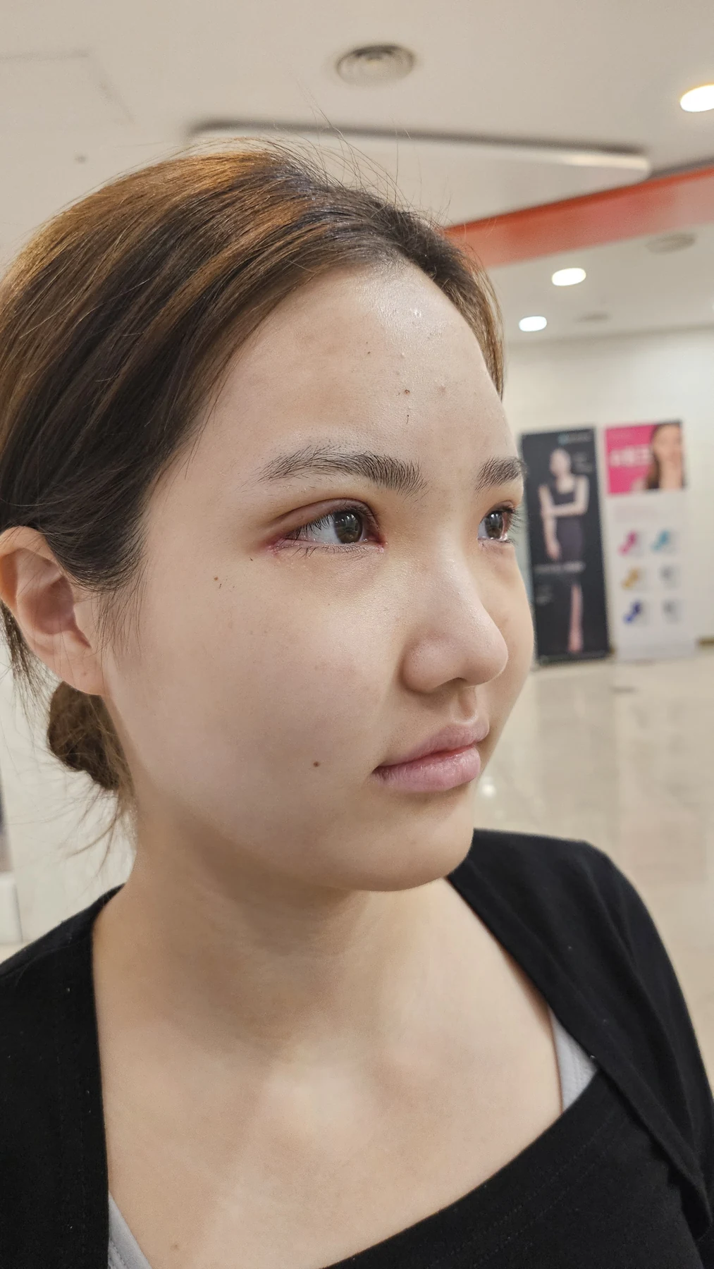 Eye-area surgery: before photos and one-month follow-up · Case 067 at Answer Plastic Surgery. Additional angled view — 1 week, eye-area surgery at Answer Plastic Surgery (case 067).