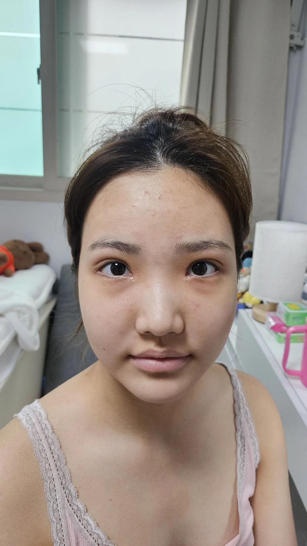Eye-area surgery: before photos and one-month follow-up · Case 067 at Answer Plastic Surgery. Front view — 2 weeks, eye-area surgery at Answer Plastic Surgery (case 067).