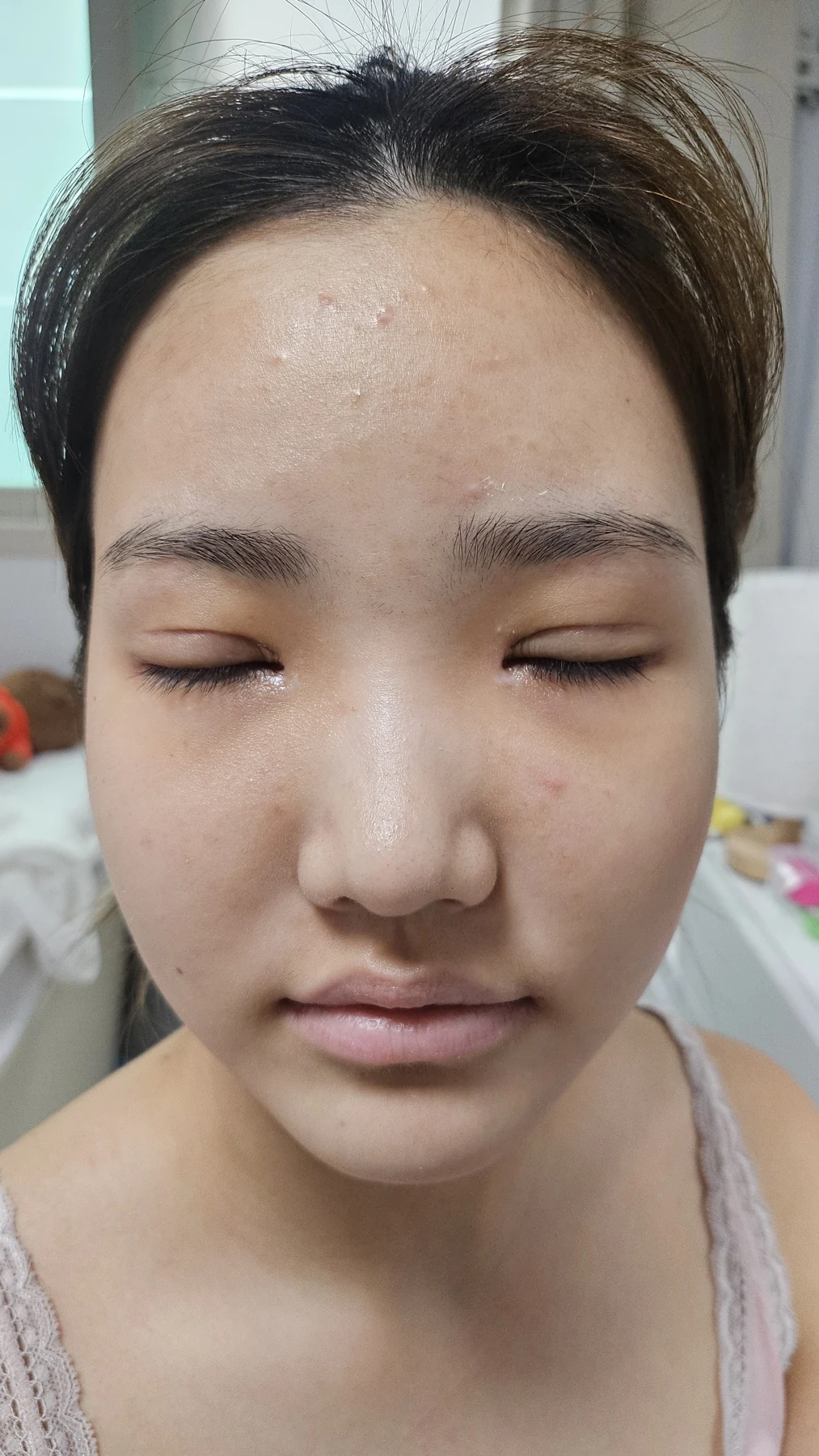 Eye-area surgery: before photos and one-month follow-up · Case 067 at Answer Plastic Surgery. Eyes-closed view — 2 weeks, eye-area surgery at Answer Plastic Surgery (case 067).