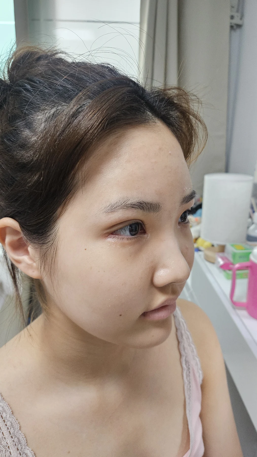 Eye-area surgery: before photos and one-month follow-up · Case 067 at Answer Plastic Surgery. Angled view — 2 weeks, eye-area surgery at Answer Plastic Surgery (case 067).
