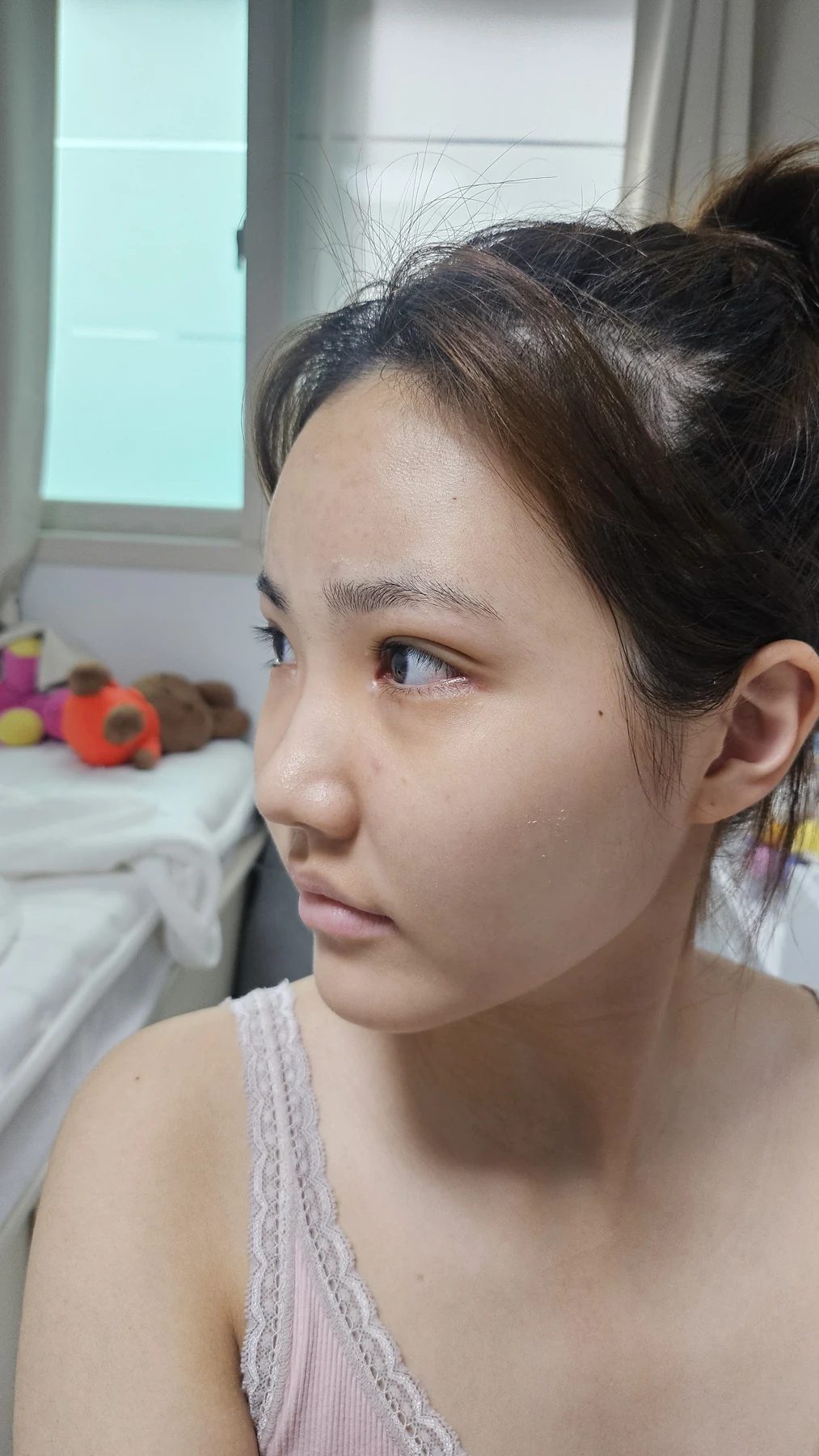 Eye-area surgery: before photos and one-month follow-up · Case 067 at Answer Plastic Surgery. Additional angled view — 2 weeks, eye-area surgery at Answer Plastic Surgery (case 067).