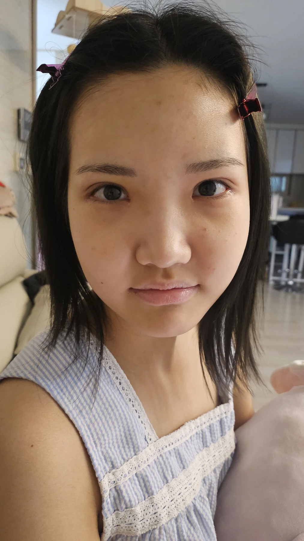 Eye-area surgery: before photos and one-month follow-up · Case 067 at Answer Plastic Surgery. Front view — 3 weeks, eye-area surgery at Answer Plastic Surgery (case 067).
