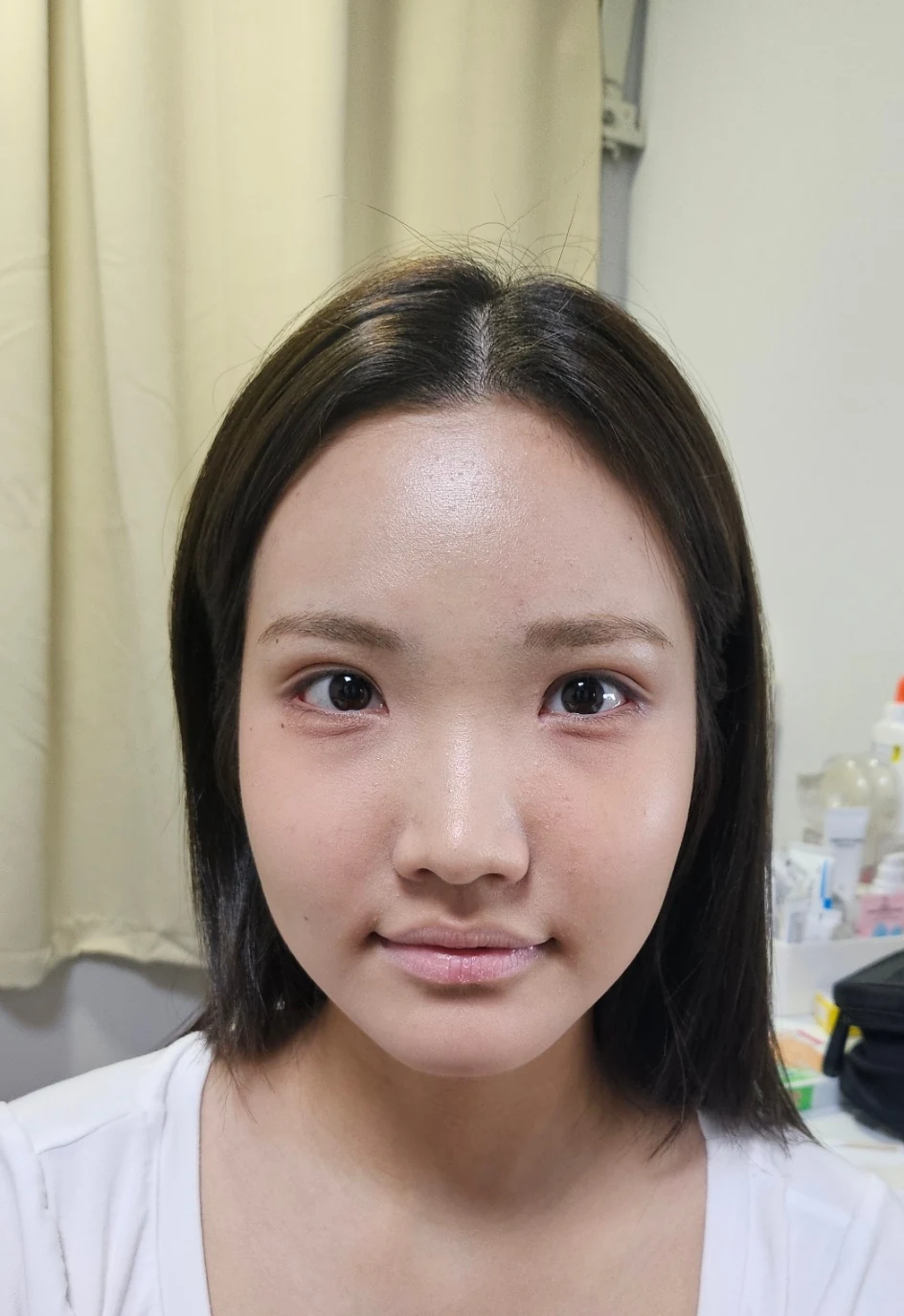 Eye-area surgery: before photos and one-month follow-up · Case 067 at Answer Plastic Surgery. Front view — 1 month, eye-area surgery at Answer Plastic Surgery (case 067).