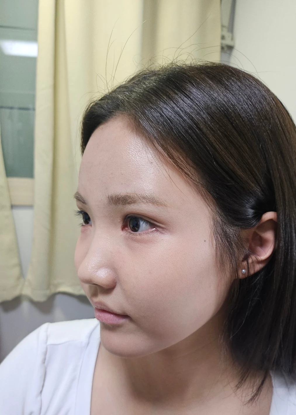 Eye-area surgery: before photos and one-month follow-up · Case 067 at Answer Plastic Surgery. Angled view — 1 month, eye-area surgery at Answer Plastic Surgery (case 067).