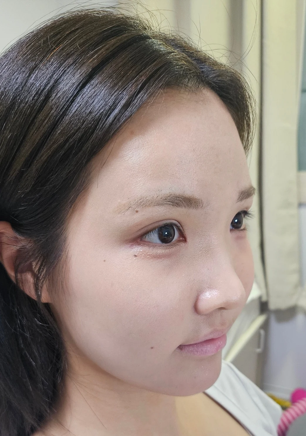 Eye-area surgery: before photos and one-month follow-up · Case 067 at Answer Plastic Surgery. Angled view — 1 month, eye-area surgery at Answer Plastic Surgery (case 067).