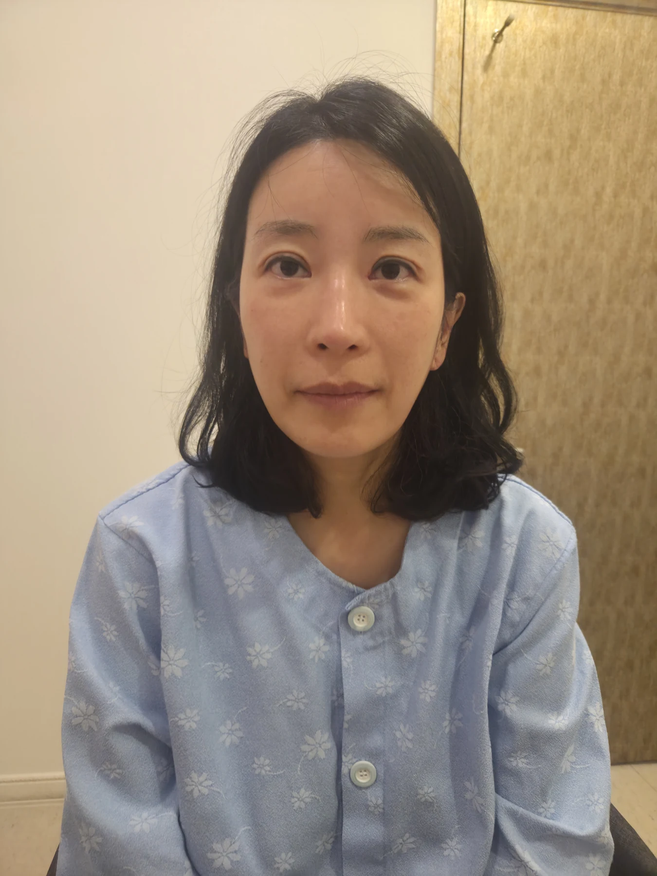 Wonder canthoplasty and eyelid correction: two-month diary · Case 068 at Answer Plastic Surgery. Front view — before, wonder canthoplasty and eyelid correction at Answer Plastic Surgery (case 068).
