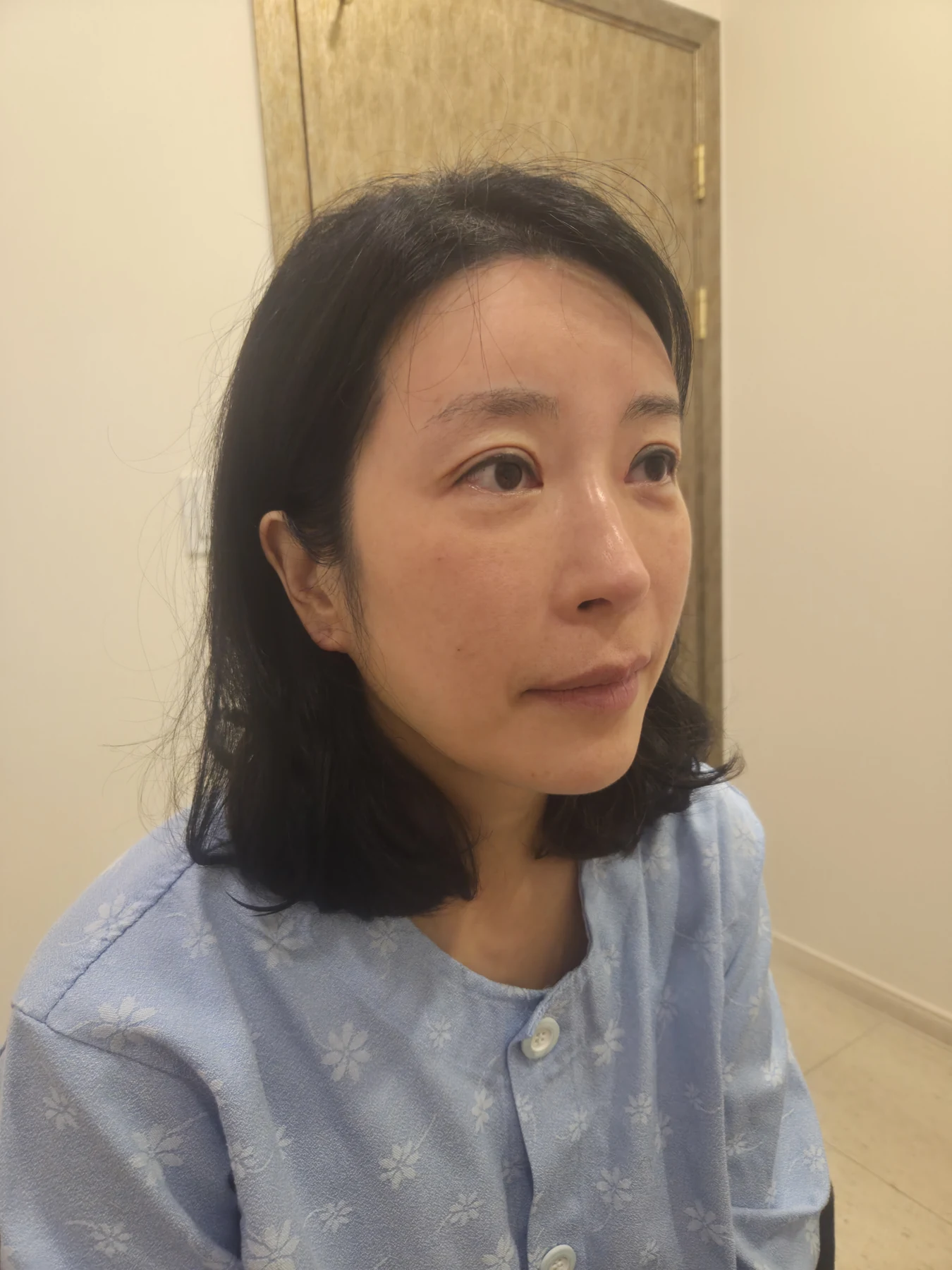 Wonder canthoplasty and eyelid correction: two-month diary · Case 068 at Answer Plastic Surgery. Angled view — before, wonder canthoplasty and eyelid correction at Answer Plastic Surgery (case 068).