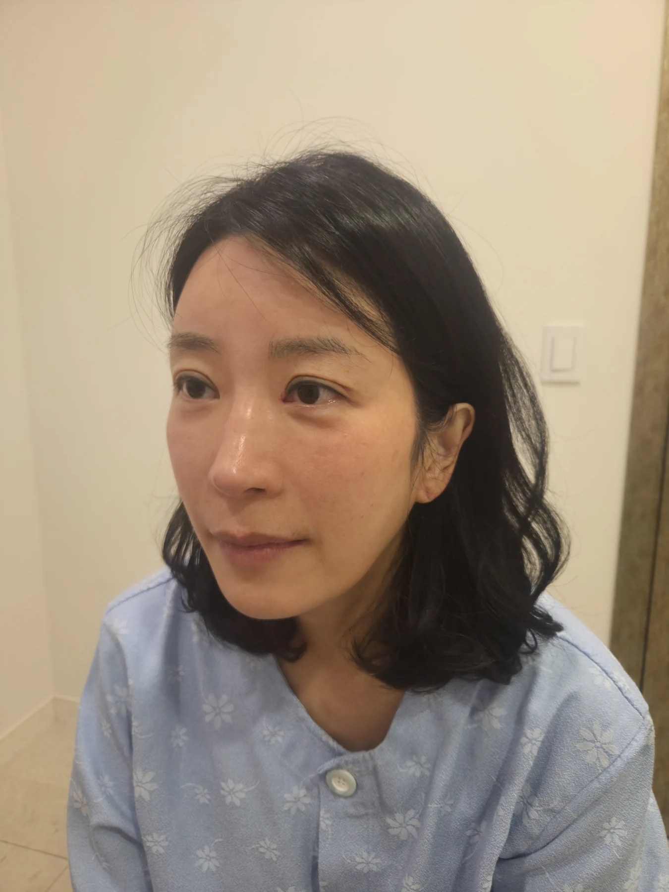 Wonder canthoplasty and eyelid correction: two-month diary · Case 068 at Answer Plastic Surgery. Additional angled view — before, wonder canthoplasty and eyelid correction at Answer Plastic Surgery (case 068).