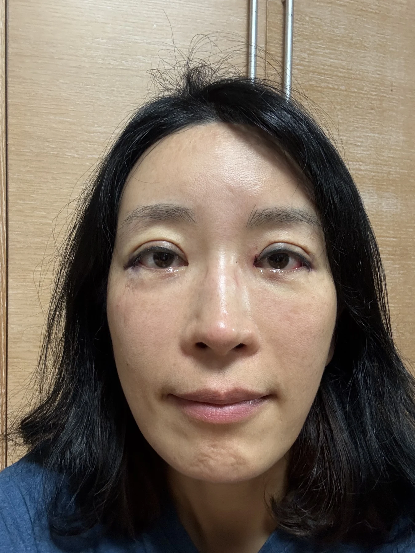 Wonder canthoplasty and eyelid correction: two-month diary · Case 068 at Answer Plastic Surgery. Front view — day of surgery, wonder canthoplasty and eyelid correction at Answer Plastic Surgery (case 068).