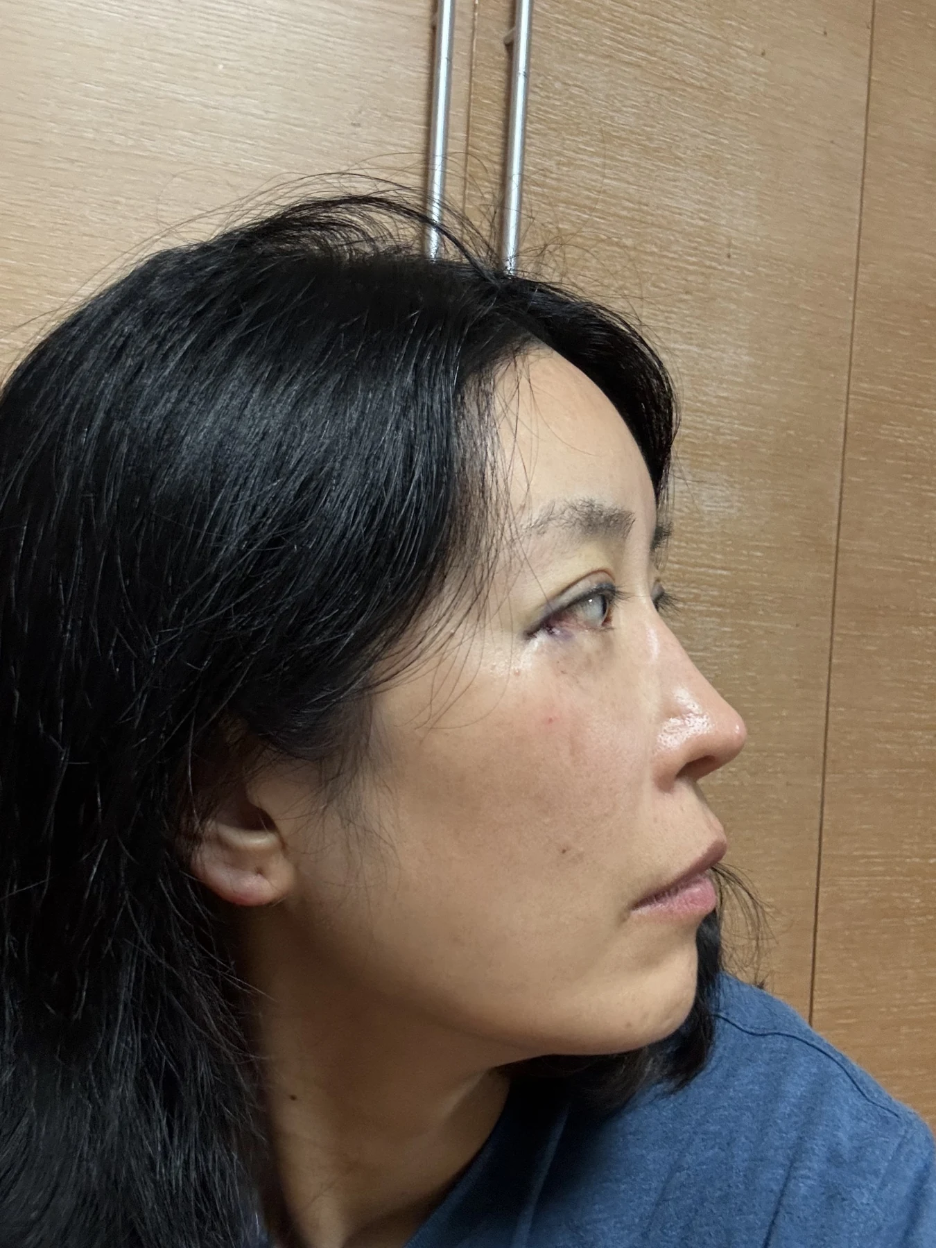 Wonder canthoplasty and eyelid correction: two-month diary · Case 068 at Answer Plastic Surgery. Angled view — day of surgery, wonder canthoplasty and eyelid correction at Answer Plastic Surgery (case 068).