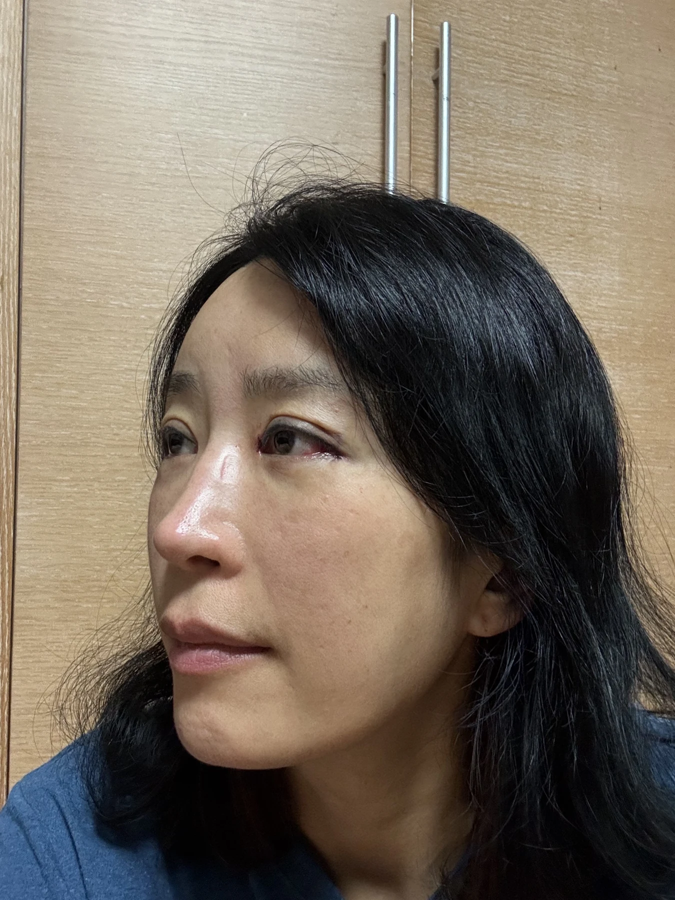 Wonder canthoplasty and eyelid correction: two-month diary · Case 068 at Answer Plastic Surgery. Additional angled view — day of surgery, wonder canthoplasty and eyelid correction at Answer Plastic Surgery (case 068).