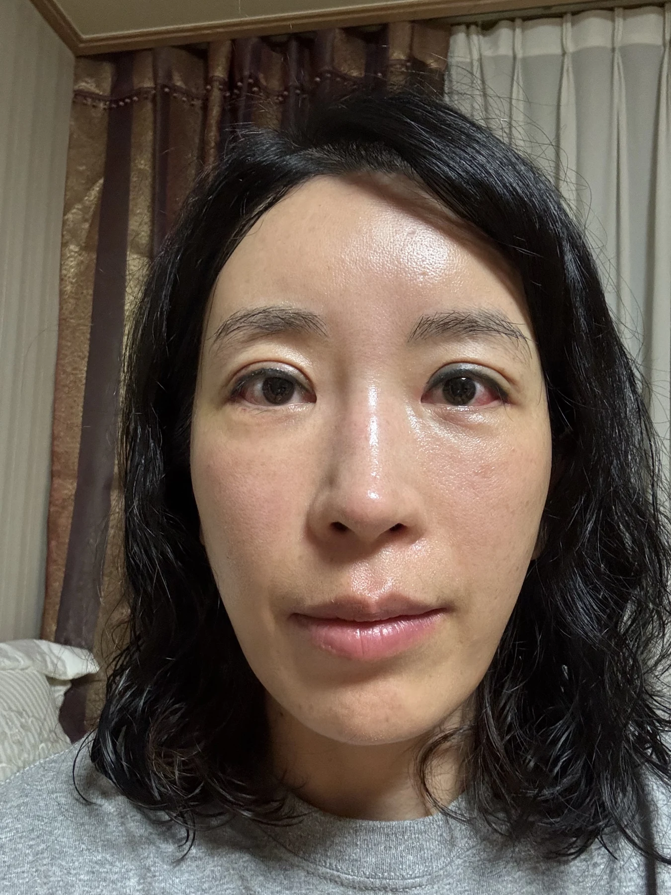 Wonder canthoplasty and eyelid correction: two-month diary · Case 068 at Answer Plastic Surgery. Front view — 1 week, wonder canthoplasty and eyelid correction at Answer Plastic Surgery (case 068).
