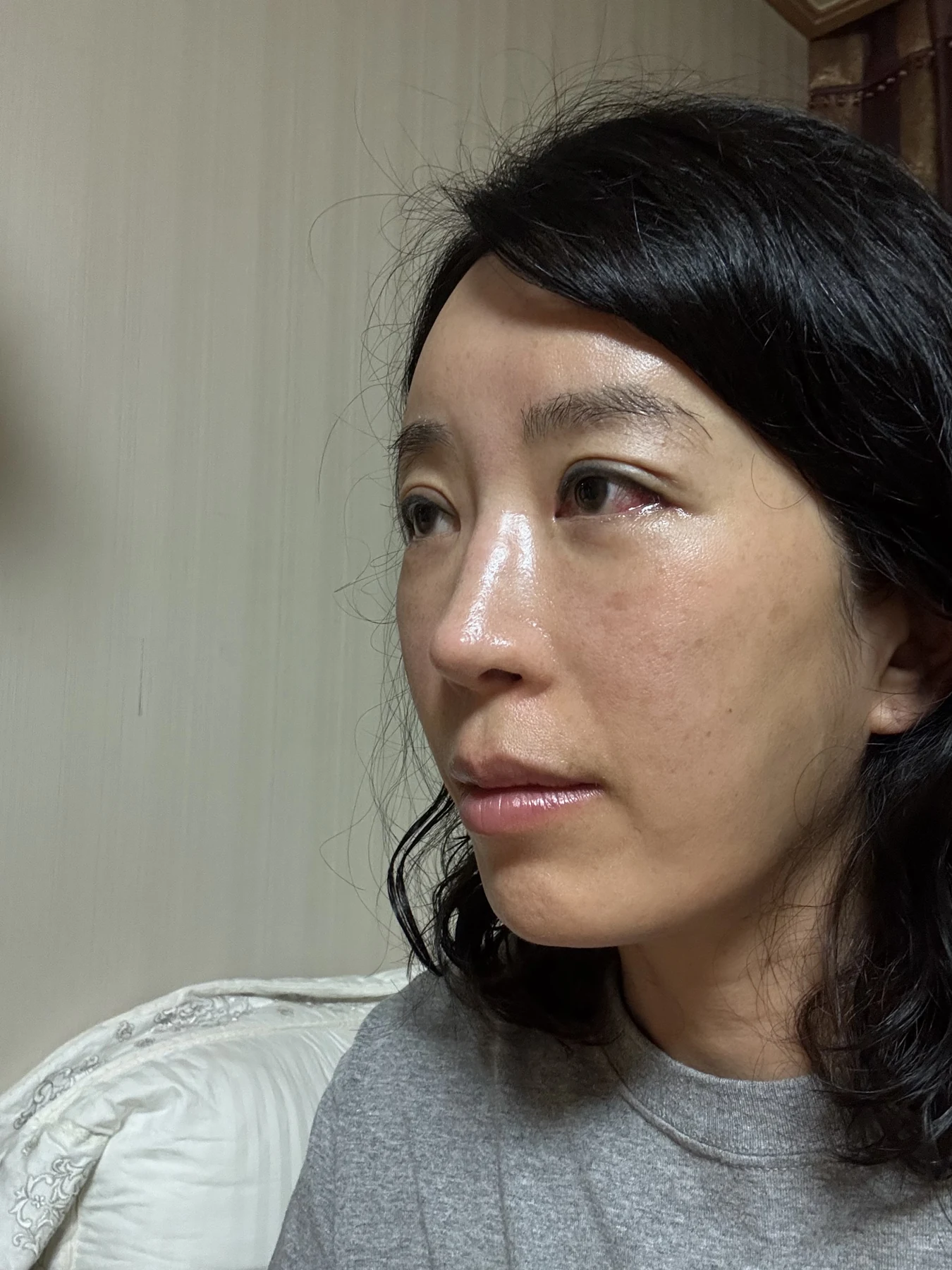 Wonder canthoplasty and eyelid correction: two-month diary · Case 068 at Answer Plastic Surgery. Angled view — 1 week, wonder canthoplasty and eyelid correction at Answer Plastic Surgery (case 068).