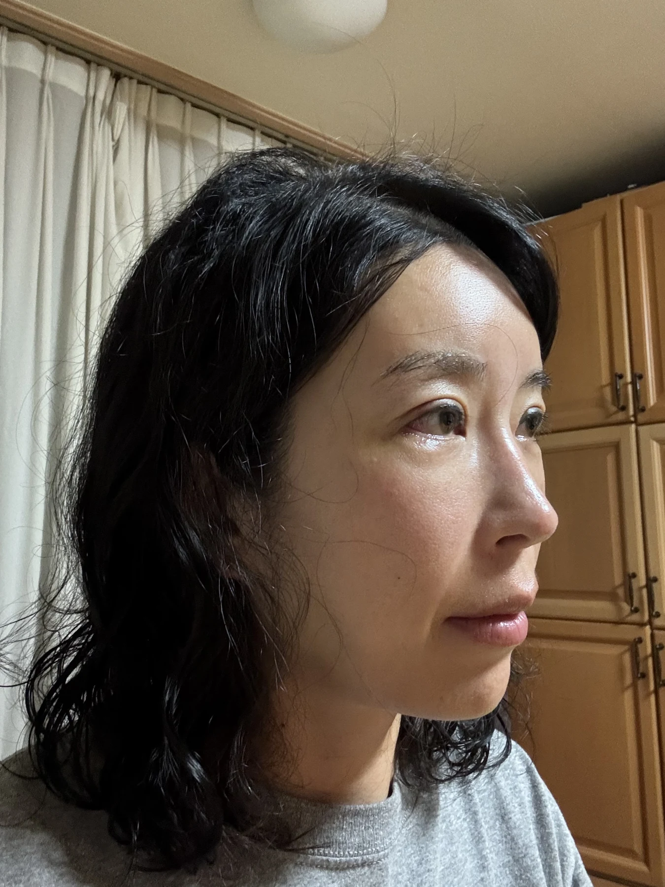 Wonder canthoplasty and eyelid correction: two-month diary · Case 068 at Answer Plastic Surgery. Additional angled view — 1 week, wonder canthoplasty and eyelid correction at Answer Plastic Surgery (case 068).