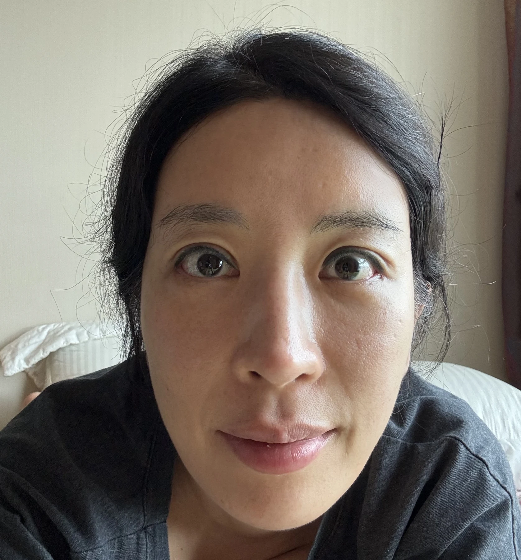 Wonder canthoplasty and eyelid correction: two-month diary · Case 068 at Answer Plastic Surgery. Front view — 2 weeks, wonder canthoplasty and eyelid correction at Answer Plastic Surgery (case 068).