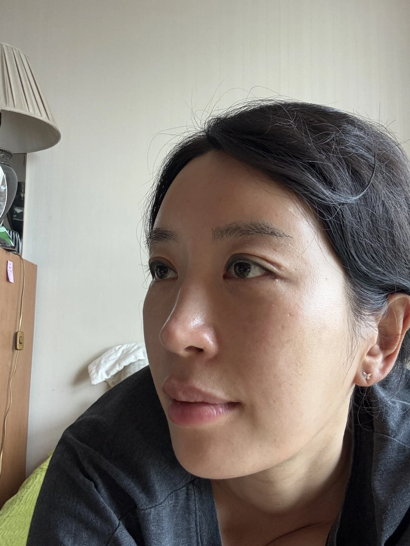 Wonder canthoplasty and eyelid correction: two-month diary · Case 068 at Answer Plastic Surgery. Additional angled view — 2 weeks, wonder canthoplasty and eyelid correction at Answer Plastic Surgery (case 068).