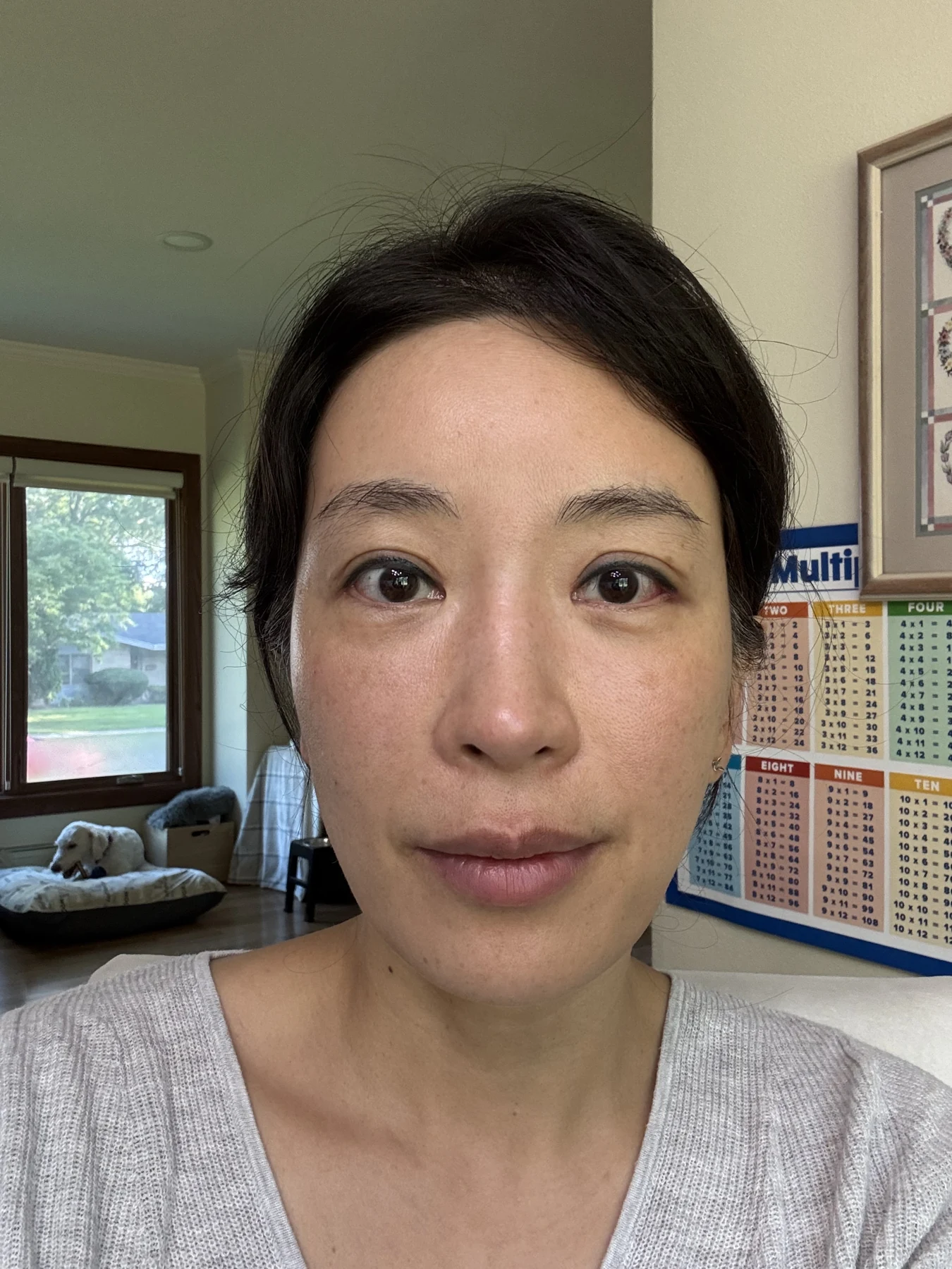 Wonder canthoplasty and eyelid correction: two-month diary · Case 068 at Answer Plastic Surgery. Front view — 1 month, wonder canthoplasty and eyelid correction at Answer Plastic Surgery (case 068).