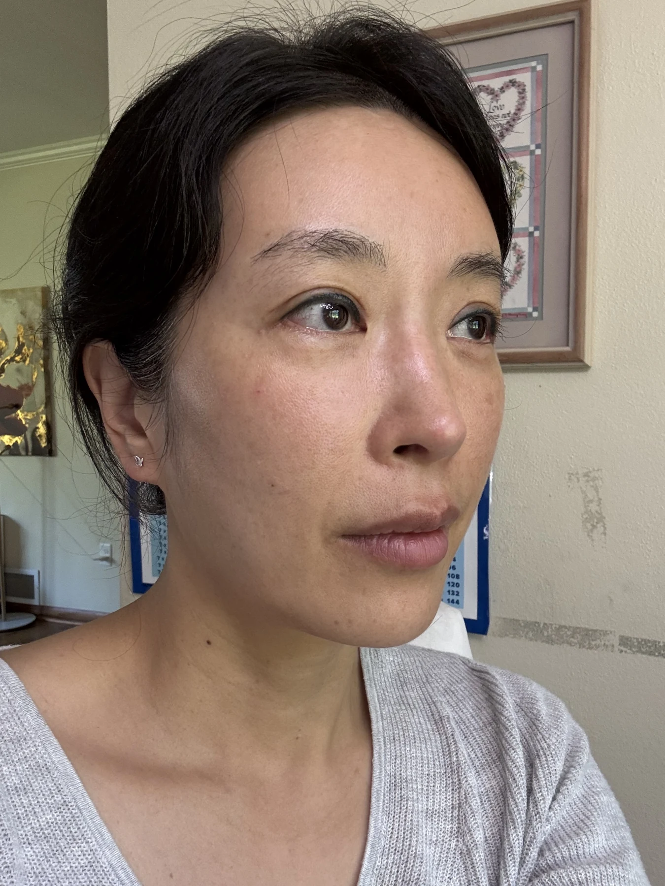Wonder canthoplasty and eyelid correction: two-month diary · Case 068 at Answer Plastic Surgery. Angled view — 1 month, wonder canthoplasty and eyelid correction at Answer Plastic Surgery (case 068).