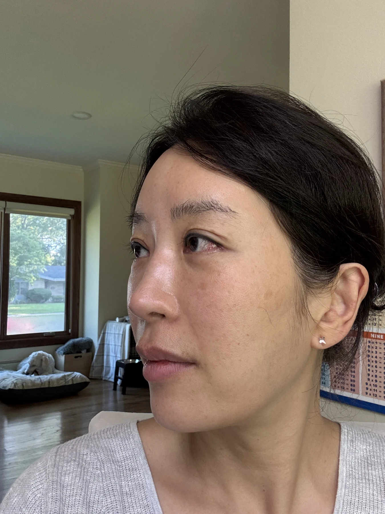 Wonder canthoplasty and eyelid correction: two-month diary · Case 068 at Answer Plastic Surgery. Additional angled view — 1 month, wonder canthoplasty and eyelid correction at Answer Plastic Surgery (case 068).