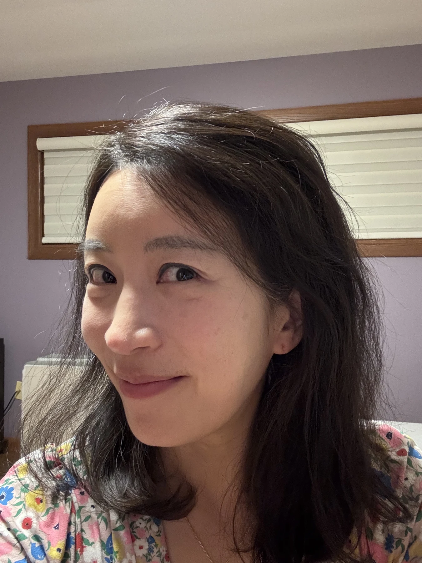 Wonder canthoplasty and eyelid correction: two-month diary · Case 068 at Answer Plastic Surgery. Additional angled view — 2 months, wonder canthoplasty and eyelid correction at Answer Plastic Surgery (case 068).