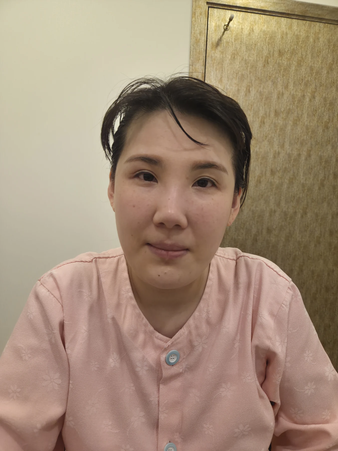 Revision inner-corner surgery and Wonder canthoplasty: six-month diary · Case 069 at Answer Plastic Surgery. Front view — before, revision inner-corner surgery and wonder canthoplasty at Answer Plastic Surgery (case 069).