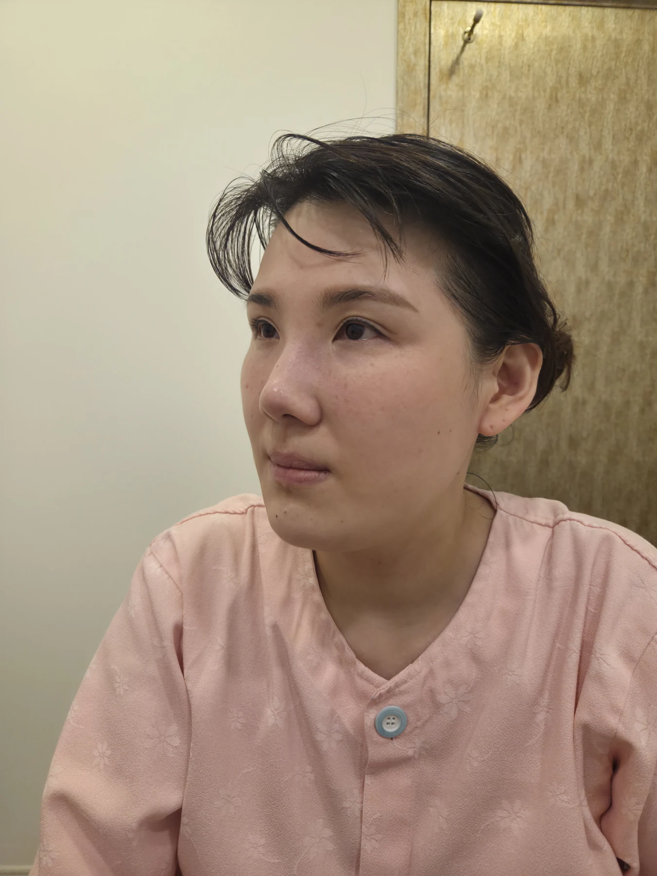 Revision inner-corner surgery and Wonder canthoplasty: six-month diary · Case 069 at Answer Plastic Surgery. Angled view — before, revision inner-corner surgery and wonder canthoplasty at Answer Plastic Surgery (case 069).