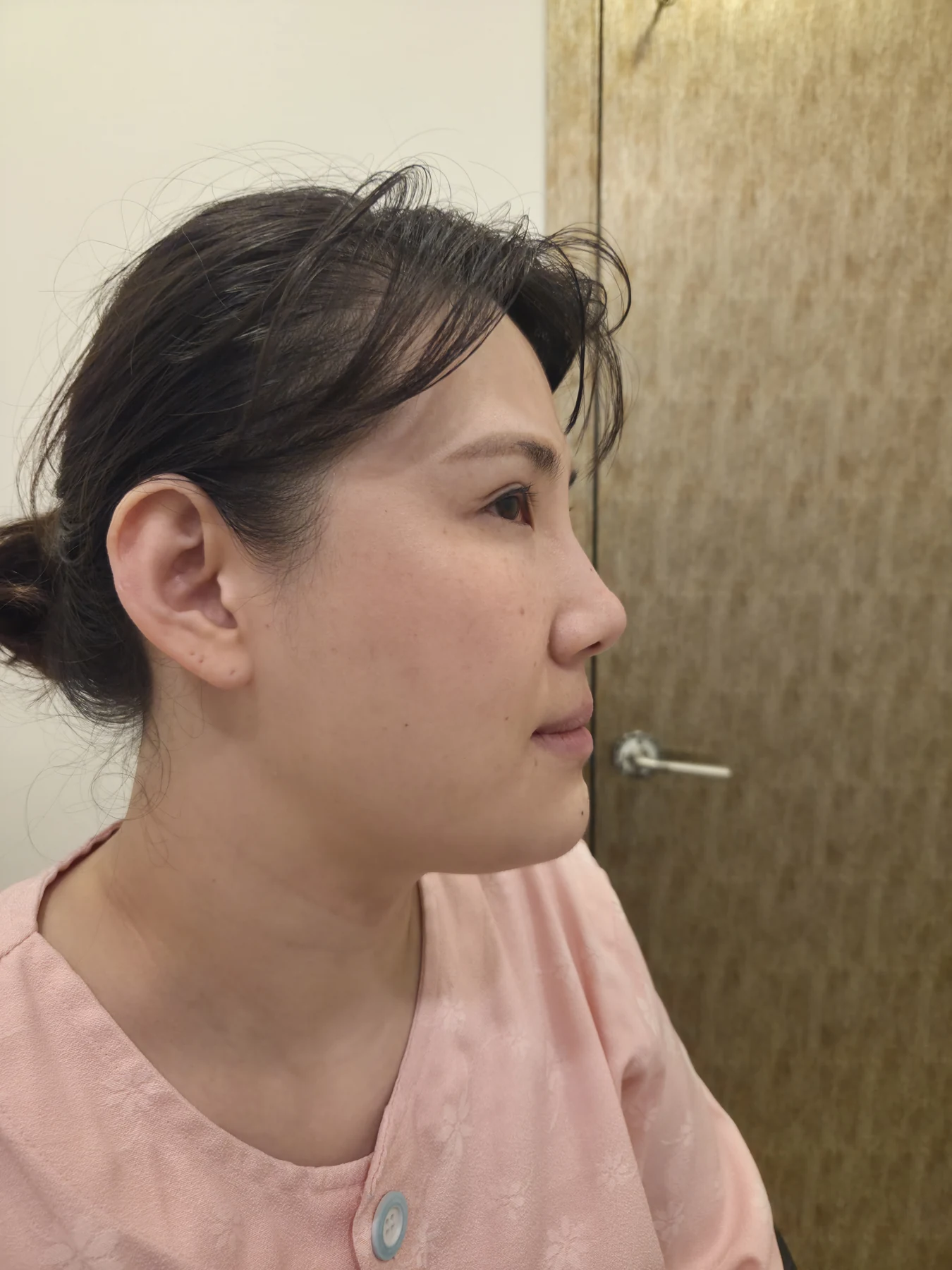 Revision inner-corner surgery and Wonder canthoplasty: six-month diary · Case 069 at Answer Plastic Surgery. Additional angled view — before, revision inner-corner surgery and wonder canthoplasty at Answer Plastic Surgery (case 069).