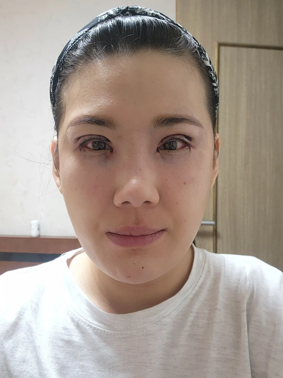 Revision inner-corner surgery and Wonder canthoplasty: six-month diary · Case 069 at Answer Plastic Surgery. Front view — day of surgery, revision inner-corner surgery and wonder canthoplasty at Answer Plastic Surgery (case 069).