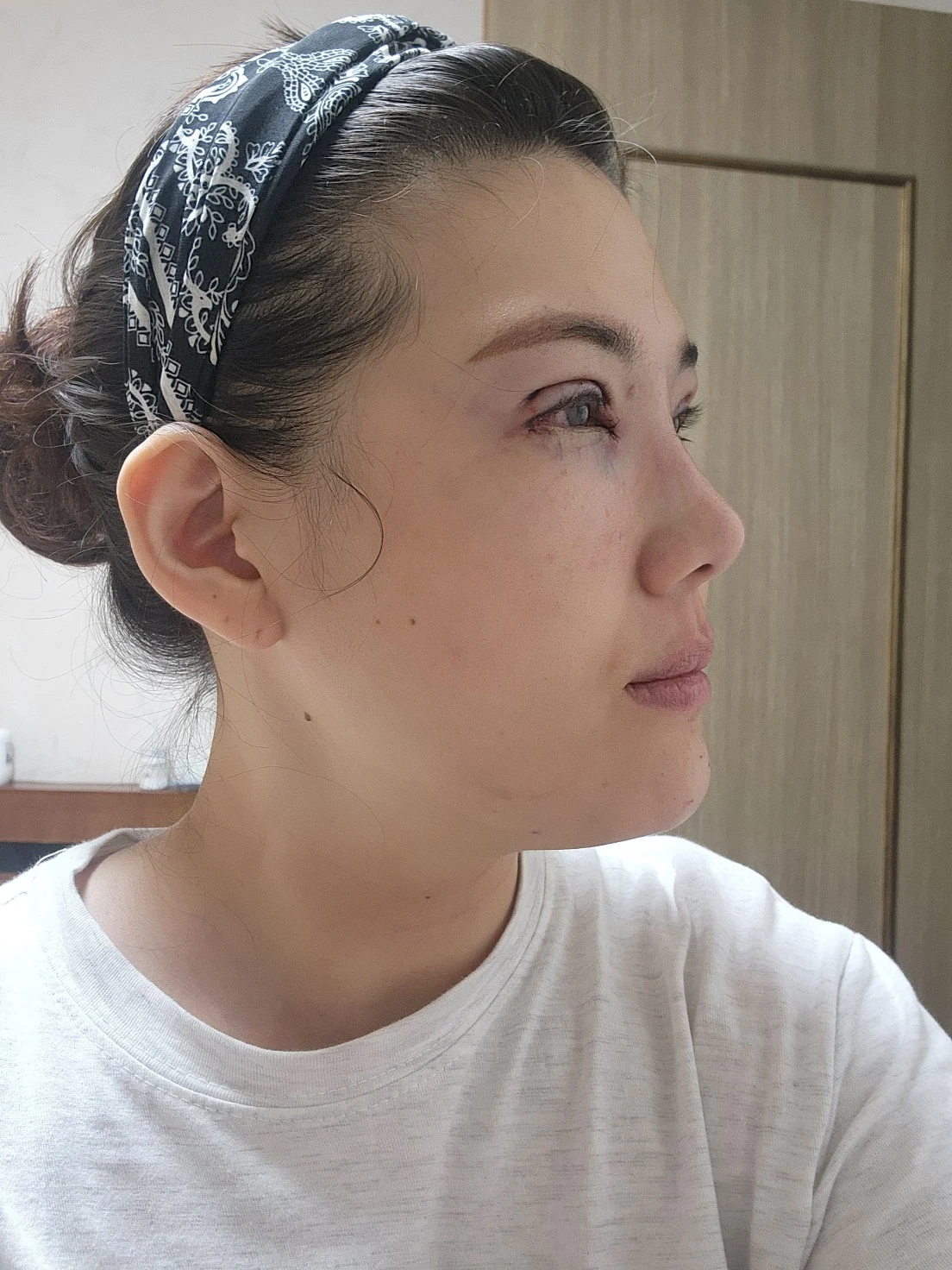 Revision inner-corner surgery and Wonder canthoplasty: six-month diary · Case 069 at Answer Plastic Surgery. Angled view — day of surgery, revision inner-corner surgery and wonder canthoplasty at Answer Plastic Surgery (case 069).
