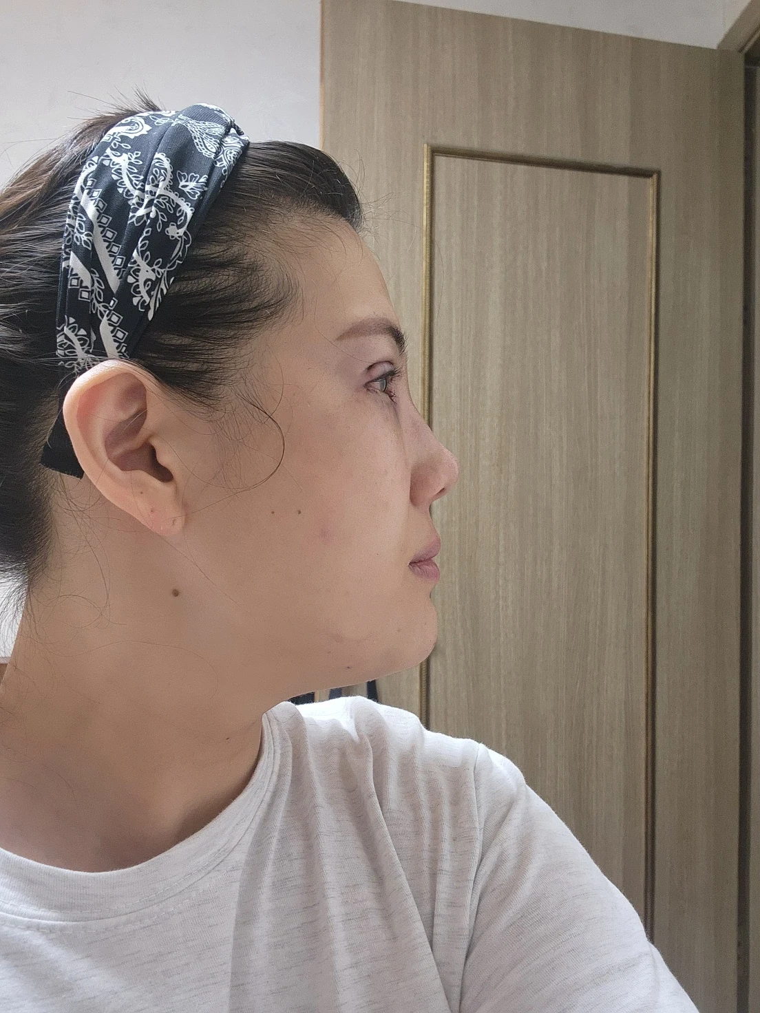 Revision inner-corner surgery and Wonder canthoplasty: six-month diary · Case 069 at Answer Plastic Surgery. Additional angled view — day of surgery, revision inner-corner surgery and wonder canthoplasty at Answer Plastic Surgery (case 069).