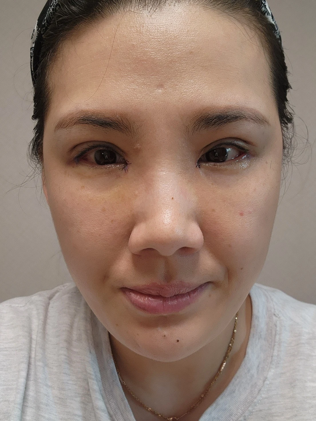 Revision inner-corner surgery and Wonder canthoplasty: six-month diary · Case 069 at Answer Plastic Surgery. Front view — 1 week, revision inner-corner surgery and wonder canthoplasty at Answer Plastic Surgery (case 069).