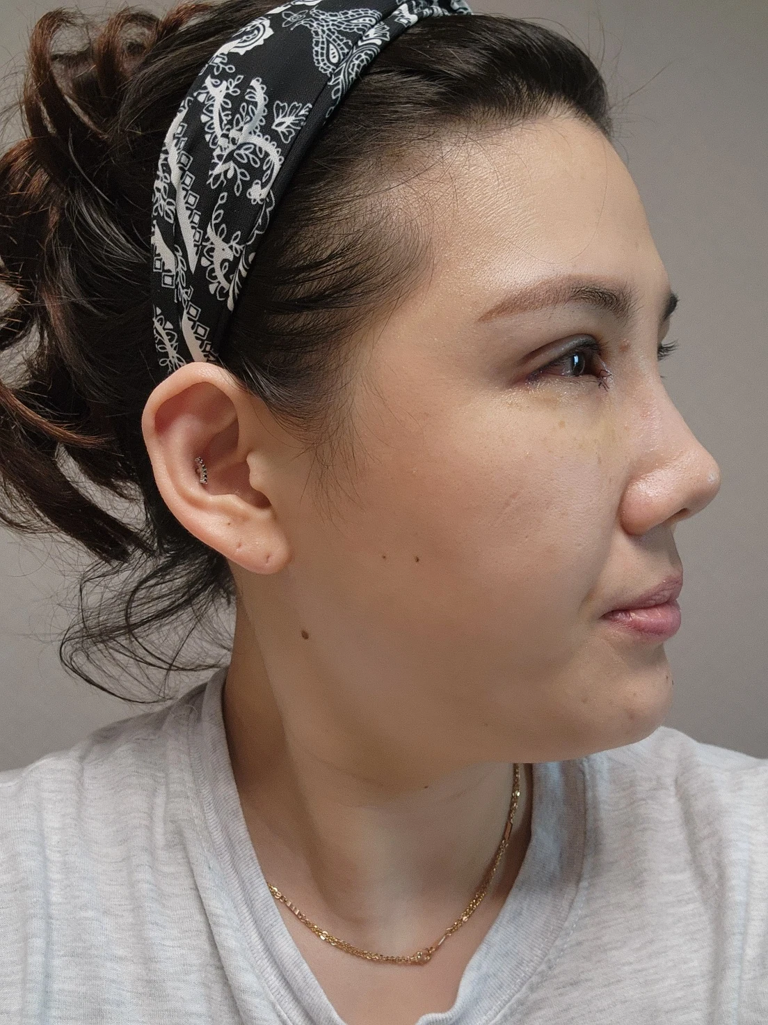 Revision inner-corner surgery and Wonder canthoplasty: six-month diary · Case 069 at Answer Plastic Surgery. Angled view — 1 week, revision inner-corner surgery and wonder canthoplasty at Answer Plastic Surgery (case 069).