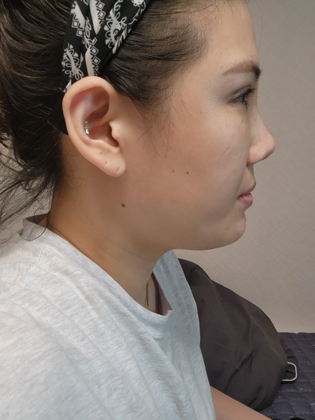 Revision inner-corner surgery and Wonder canthoplasty: six-month diary · Case 069 at Answer Plastic Surgery. Additional angled view — 1 week, revision inner-corner surgery and wonder canthoplasty at Answer Plastic Surgery (case 069).