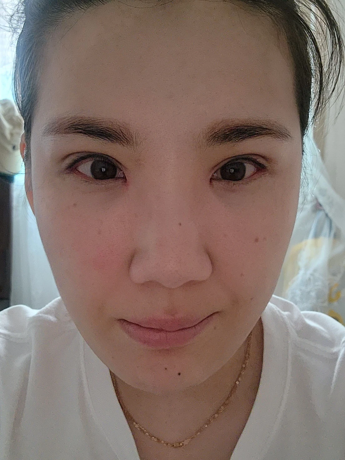 Revision inner-corner surgery and Wonder canthoplasty: six-month diary · Case 069 at Answer Plastic Surgery. Front view — 2 weeks, revision inner-corner surgery and wonder canthoplasty at Answer Plastic Surgery (case 069).