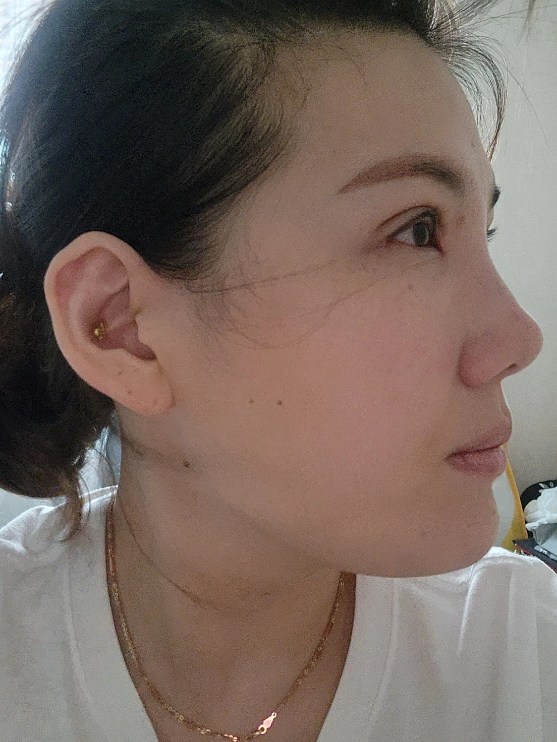 Revision inner-corner surgery and Wonder canthoplasty: six-month diary · Case 069 at Answer Plastic Surgery. Angled view — 2 weeks, revision inner-corner surgery and wonder canthoplasty at Answer Plastic Surgery (case 069).